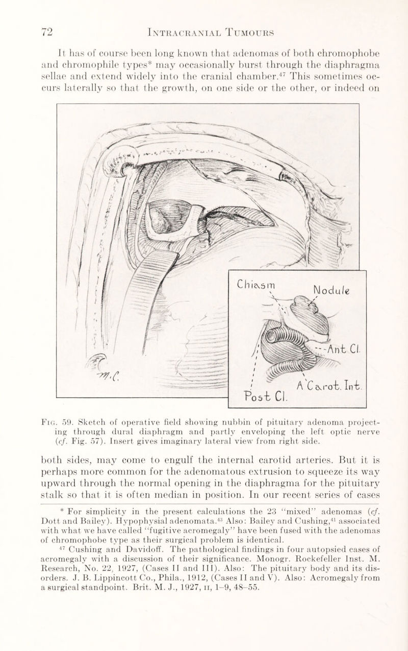 It has of course been long known that adenomas of both chromophobe and chromophile types* may occasionally burst through the diaphragma sellae and extend widely into the cranial chamber.47 This sometimes oc¬ curs laterally so that the growth, on one side or the other, or indeed on Fig. 59. Sketch of operative field showing nubbin of pituitary adenoma project¬ ing through dural diaphragm and partly enveloping the left optic nerve (<?/. Fig. 57). Insert gives imaginary lateral view from right side. both sides, may come to engulf the internal carotid arteries. But it is perhaps more common for the adenomatous extrusion to squeeze its way upward through the normal opening in the diaphragma for the pituitary stalk so that it is often median in position. In our recent series of cases * For simplicity in the present calculations the 23 “mixed” adenomas (cf. Dott and Bailey). Hypophysial adenomata.43 Also: Bailey and Cushing,41 associated with what we have called “fugitive acromegaly” have been fused with the adenomas of chromophobe type as their surgical problem is identical. 47 Cushing and Davidoff. The pathological findings in four autopsied cases of acromegaly with a discussion of their significance. Monogr. Rockefeller Inst. M. Research, No. 22, 1927, (Cases II and III). Also: The pituitary body and its dis¬ orders. J. B. Lippincott Co., Phila., 1912, (Cases II and V). Also: Acromegaly from a surgical standpoint. Brit. M. J., 1927, ii, 1-9, 48-55.