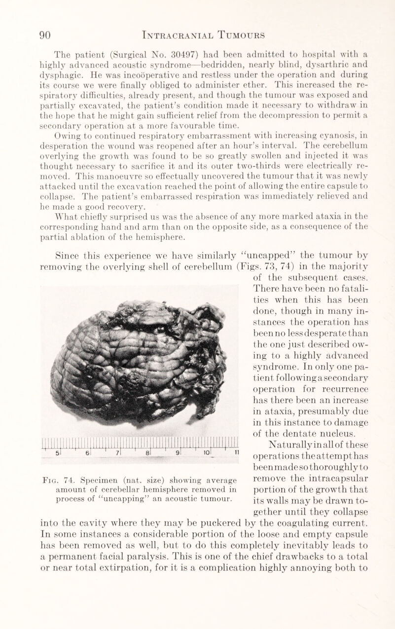 The patient (Surgical No. 30497) had been admitted to hospital with a highly advanced acoustic syndrome—bedridden, nearly blind, dysarthric and dysphagic. He was incooperative and restless under the operation and during its course we were finally obliged to administer ether. This increased the re¬ spiratory difficulties, already present, and though the tumour was exposed and partially excavated, the patient’s condition made it necessary to withdraw in the hope that he might gain sufficient relief from the decompression to permit a secondary operation at a more favourable time. Owing to continued respiratory embarrassment with increasing cyanosis, in desperation the wound was reopened after an hour’s interval. The cerebellum overlying the growth was found to be so greatly swollen and injected it was thought necessary to sacrifice it and its outer two-thirds were electrically re¬ moved. This manoeuvre so effectually uncovered the tumour that it was newly attacked until the excavation reached the point of allowing the entire capsule to collapse. The patient’s embarrassed respiration was immediately relieved and he made a good recovery. What chiefly surprised us was the absence of any more marked ataxia in the corresponding hand and arm than on the opposite side, as a consequence of the partial ablation of the hemisphere. Since this experience we have similarly “uncapped the tumour by removing the overlying shell of cerebellum (Figs. 73, 74) in the majority of the subsequent cases. There have been no fatali¬ ties when this has been done, though in many in¬ stances the operation has been no less desperate than the one just described ow¬ ing to a highly advanced syndrome. In only one pa¬ tient following a secondary operation for recurrence has there been an increase in ataxia, presumably due in this instance to damage of the dentate nucleus. Naturally in all of these operations the attempt has been made so thoroughly to remove the intracapsular portion of the growth that its walls may be drawn to¬ gether until they collapse into the cavity where they may be puckered by the coagulating current. In some instances a considerable portion of the loose and empty capsule has been removed as well, but to do this completely inevitably leads to a permanent facial paralysis. This is one of the chief drawbacks to a total or near total extirpation, for it is a complication highly annoying both to Fig. 74. Specimen (nat. size) showing average amount of cerebellar hemisphere removed in process of “uncapping” an acoustic tumour.