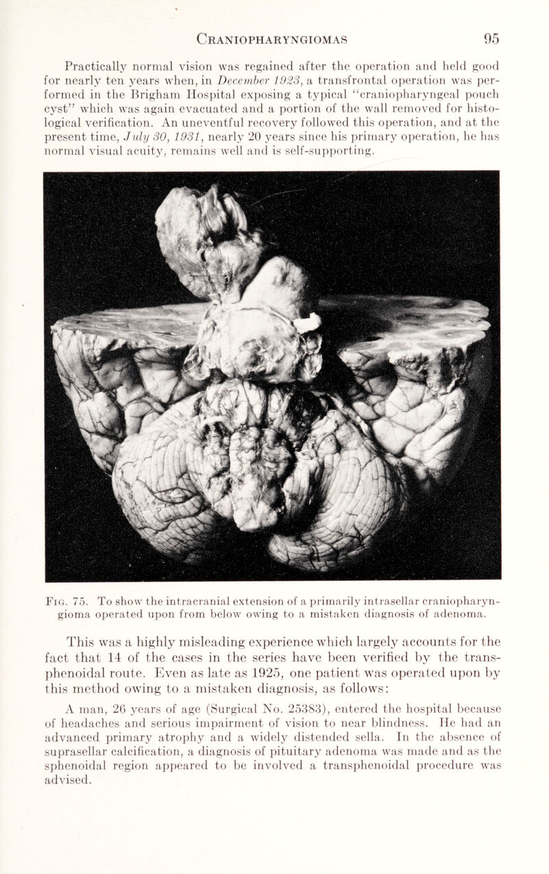 Practically normal vision was regained after the operation and held good for nearly ten years when, in December 1923, a transfrontal operation was per¬ formed in the Brigham Hospital exposing a typical “craniopharyngeal pouch cyst” which was again evacuated and a portion of the wall removed for histo¬ logical verification. An uneventful recovery followed this operation, and at the present time, July 30, 1931, nearly 20 years since his primary operation, he has normal visual acuity, remains well and is self-supporting. Fig. 75. To show the intracranial extension of a primarily intrasellar craniopharyn¬ gioma operated upon from below owing to a mistaken diagnosis of adenoma. This was a highly misleading experience which largely accounts for the fact that 14 of the cases in the series have been verified by the trans- phenoidal route. Even as late as 1925, one patient was operated upon by this method owing to a mistaken diagnosis, as follows: A man, 26 years of age (Surgical No. 25383), entered the hospital because of headaches and serious impairment of vision to near blindness. He had an advanced primary atrophy and a widely distended sella. In the absence of suprasellar calcification, a diagnosis of pituitary adenoma was made and as the sphenoidal region appeared to be involved a transphenoidal procedure was advised.