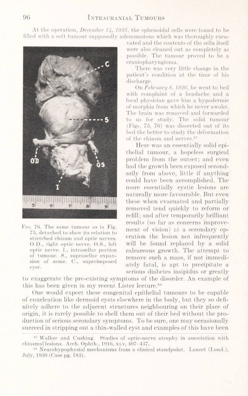 At the operation, December 1/+, 192b, the sphenoidal cells were found to be filled with a soft tumour supposedly adenomatous which was thoroughly exca¬ vated and the contents of the sella itself Fig. 76. The same tumour as in Fig. 75, detached to show its relation to stretched chiasm and optic nerves. O.D., right optic nerve. O.S., left optic nerve. I., intrasellar portion of tumour. S., suprasellar expan¬ sion of same. C., superimposed cyst. were also cleaned out as completely as possible. The tumour proved to be a c r a n i o ph ary n gio ina. There was very little change in the patient’s condition at the time of his discharge. On February 8, 1926, he went to bed with complaint of a headache and a local physician gave him a hypodermic of morphia from which he never awoke. The brain was removed and forwarded to us for study. The solid tumour (Figs. 75, 76) was dissected out of its bed the better to study the deformation of the chiasm and nerves.67 Here was an essentially solid epi¬ thelial tumour, a hopeless surgical problem from the outset; and even had the growth been exposed second¬ arily from above, little if anything could have been accomplished. The more essentially cystic lesions are naturally more favourable. But even these when evacuated and partially removed tend quickly to reform or refill; and after temporarily brilliant results (so far as concerns improve¬ ment of vision) at a secondary op¬ eration the lesion not infrequently will be found replaced by a solid calcareous growth. The attempt to remove such a mass, if not immedi¬ ately fatal, is apt to precipitate a serious diabetes insipidus or greatly to exaggerate the pre-existing symptoms of the disorder. An example of this has been given in my recent Lister lecture.68 One would expect these congenital epithelial tumours to be capable of enucleation like dermoid cysts elsewhere in the body, but they so defi¬ nitely adhere to the adjacent structures neighbouring on their place of origin, it is rarely possible to shell them out of their bed without the pro¬ duction of serious secondary symptoms. To be sure, one may occasionally succeed in stripping out a thin-walled cyst and examples of this have been 67 Walker and Cushing. Studies of optic-nerve atrophy in association with chiasmal lesions. Arch. Ophth., 1916, xlv, 407-437. 68 Neurohypophysial mechanisms from a clinical standpoint. Lancet (Lond.), July, 1930 (Casepg. 183).