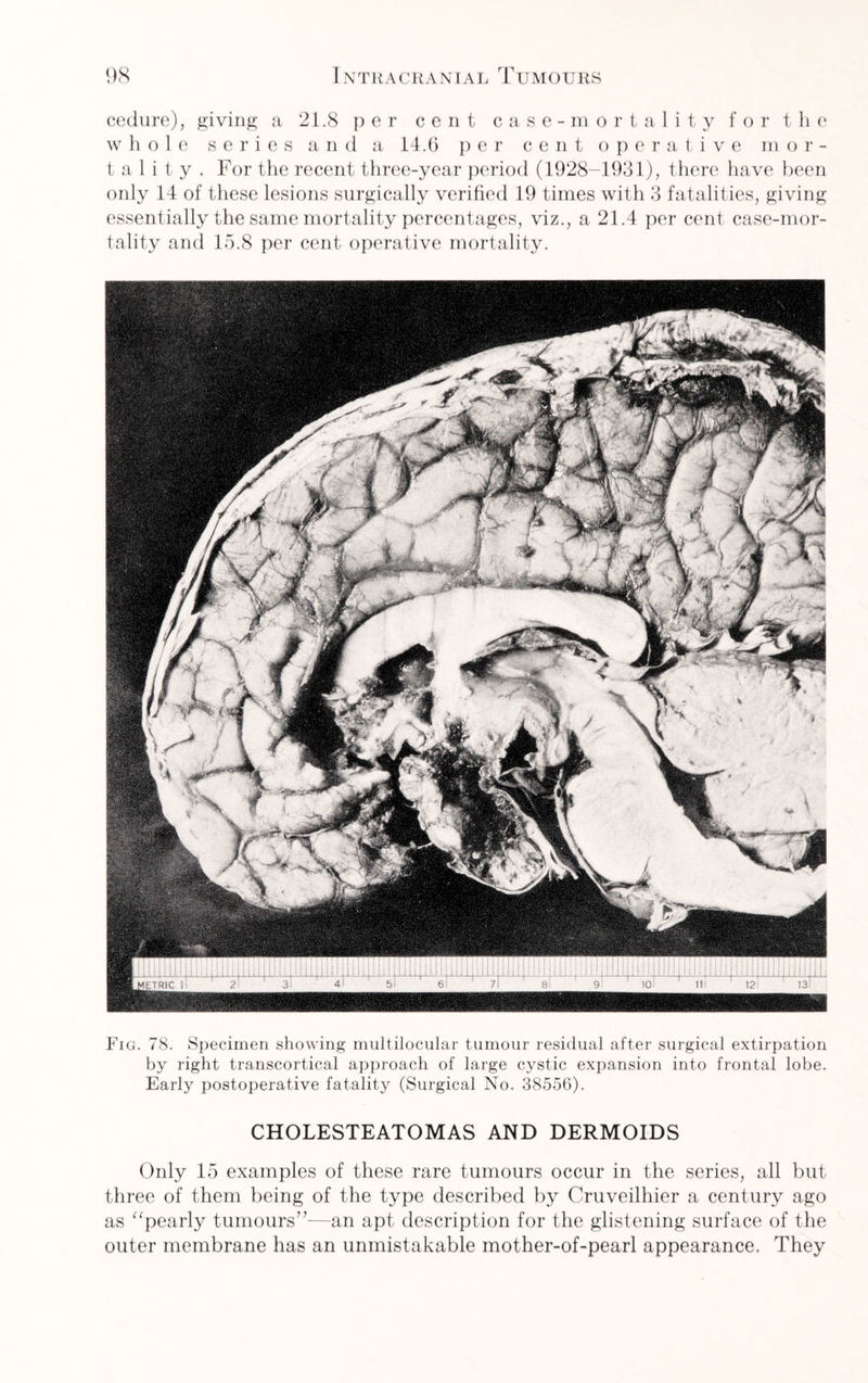 cedure), giving a 21.8 per cent case-mortality for the whole series and a 14.6 per cent operative m or- t a 1 i t y . For the recent three-year period (1928-1931), there have been only 14 of these lesions surgically verified 19 times with 3 fatalities, giving essentially the same mortality percentages, viz., a 21.4 per cent case-mor¬ tality and 15.8 per cent operative mortality. Fig. 78. Specimen showing multilocular tumour residual after surgical extirpation by right transcortical approach of large cystic expansion into frontal lobe. Early postoperative fatality (Surgical No. 38556). CHOLESTEATOMAS AND DERMOIDS Only 15 examples of these rare tumours occur in the series, all but three of them being of the type described by Cruveilhier a century ago as “pearly tumours”—an apt description for the glistening surface of the outer membrane has an unmistakable mother-of-pearl appearance. They