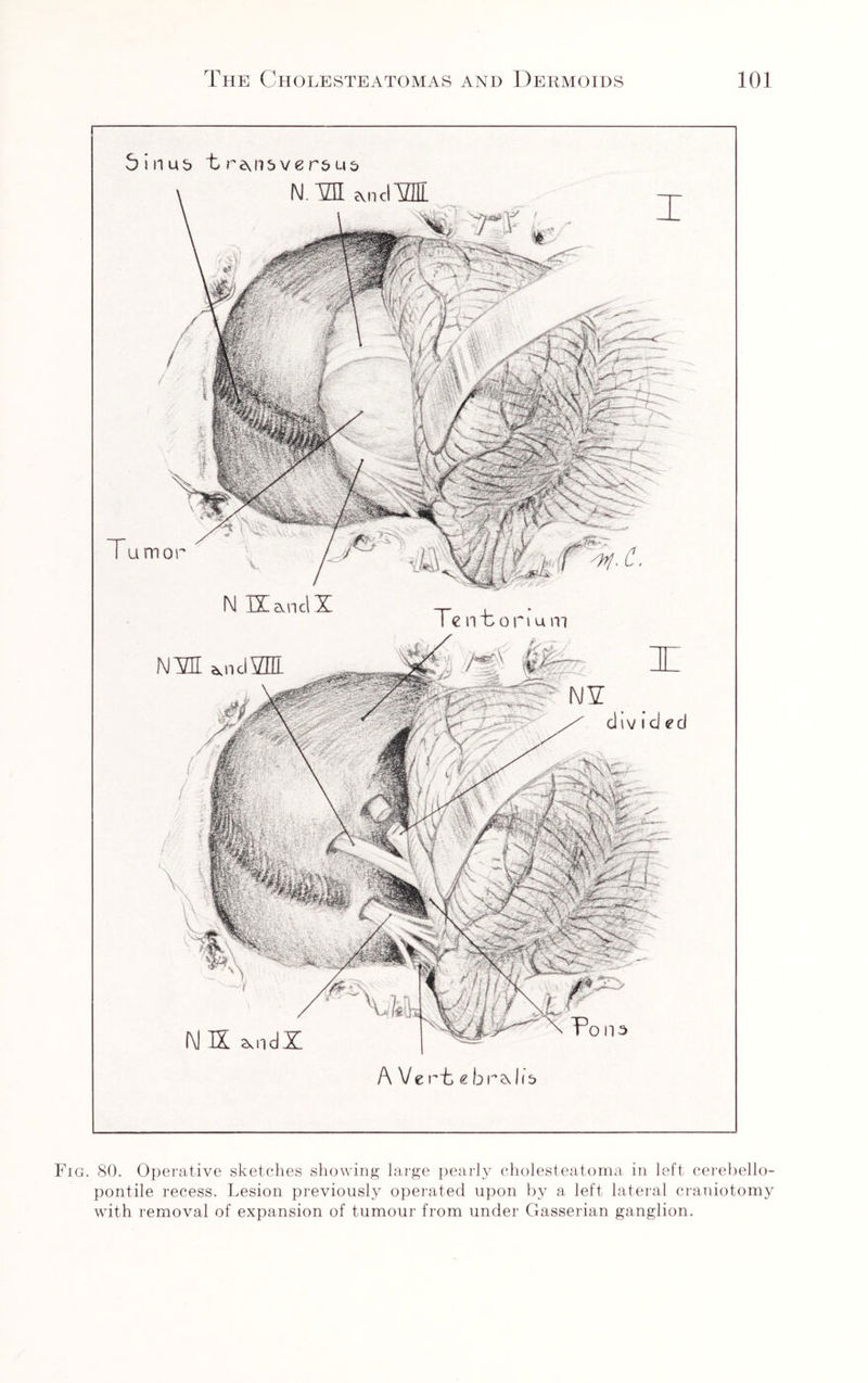 NK N.idX A Vert €bda 1(5 Te n t o n u m divided 5inus tr^nsver&ui) M VII Audi! T u mo r v N IX and X NM AndVHl Fig. 80. Operative sketches showing large pearly cholesteatoma in left cerebello- pont.ile recess. Lesion previously operated upon by a left lateral craniotomy with removal of expansion of tumour from under Gasserian ganglion.