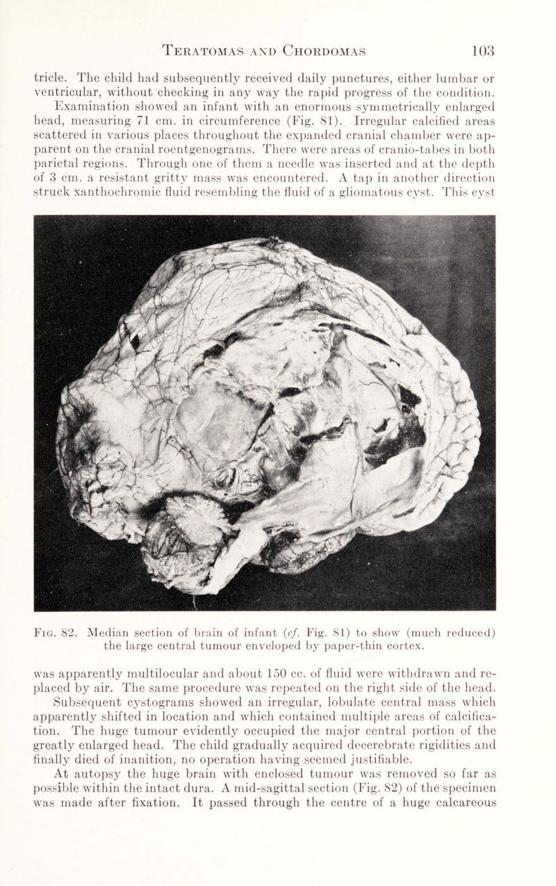 tricle. The child had subsequently received daily punctures, either lumbar or ventricular, without checking in any way the rapid progress of the condition. Examination showed an infant with an enormous symmetrically enlarged head, measuring 71 cm. in circumference (Fig. 81). Irregular calcified areas scattered in various places throughout the expanded cranial chamber were ap¬ parent on the cranial roentgenograms. There were areas of cranio-tabes in both parietal regions. Through one of them a needle was inserted and at the depth of 3 cm. a resistant gritty mass was encountered. A tap in another direction struck xanthochromic fluid resembling the fluid of a gliomatous cyst. This cyst Fig. 82. Median section of brain of infant (cf. Fig. 81) to show (much reduced) the large central tumour enveloped by paper-thin cortex. was apparently multilocular and about 150 cc. of fluid were withdrawn and re¬ placed by air. The same procedure was repeated on the right side of the head. Subsequent cystograms showed an irregular, lobulate central mass which apparently shifted in location and which contained multiple areas of calcifica¬ tion. The huge tumour evidently occupied the major central portion of the greatly enlarged head. The child gradually acquired decerebrate rigidities and finally died of inanition, no operation having seemed justifiable. At autopsy the huge brain with enclosed tumour was removed so far as possible within the intact dura. A mid-sagittal section (Fig. 82) of the specimen was made after fixation. It passed through the centre of a huge calcareous