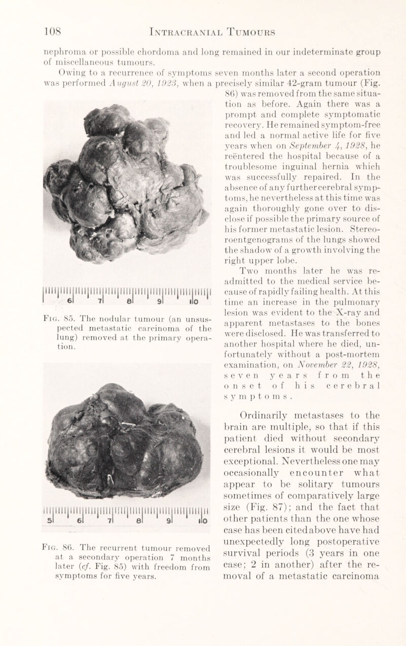 nephroma or possible chordoma and long remained in our indeterminate group of miscellaneous tumours. Owing to a recurrence of symptoms seven months later a second operation was performed August 20, 1923, when a Fig. 85. The nodular tumour (an unsus¬ pected metastatic carcinoma of the lung) removed at the primary opera¬ tion. precisely similar 42-gram tumour (Fig. 86) was removed from the same situa¬ tion as before. Again there was a prompt and complete symptomatic recovery. He remained symptom-free and led a normal active life for five years when on September 3, 1928, he reentered the hospital because of a troublesome inguinal hernia which was successfully repaired. In the absence of any further cerebral symp¬ toms, he nevertheless at this time was again thoroughly gone over to dis¬ close if possible the primary source of his former metastatic lesion. Stereo¬ roentgenograms of the lungs showed the shadow of a growth involving the right upper lobe. Two months later he was re¬ admitted to the medical service be¬ cause of rapidly failing health. At this time an increase in the pulmonary lesion was evident to the X-ray and apparent metastases to the bones were disclosed. He was transferred to another hospital where he died, un¬ fortunately without a post-mortem examination, on November 22, 1928, seven years from the onset of his cerebral s y m p t o m s . 11 lllillill lllillill lllillill lllillill iimtni 5 6 7 8 9 1 s Ordinarily metastases to the brain are multiple, so that if this patient died without secondary cerebral lesions it would be most exceptional. Nevertheless one may occasionally encounter what appear to be solitary tumours sometimes of comparatively large size (Fig. 87); and the fact that other patients than the one whose Fig. 86. The recurrent tumour removed at a secondary operation 7 months later (cf. Fig. 85) with freedom from symptoms for five years. case has been cited above have had unexpectedly long postoperative survival periods (3 years in one case; 2 in another) after the re¬ moval of a metastatic carcinoma