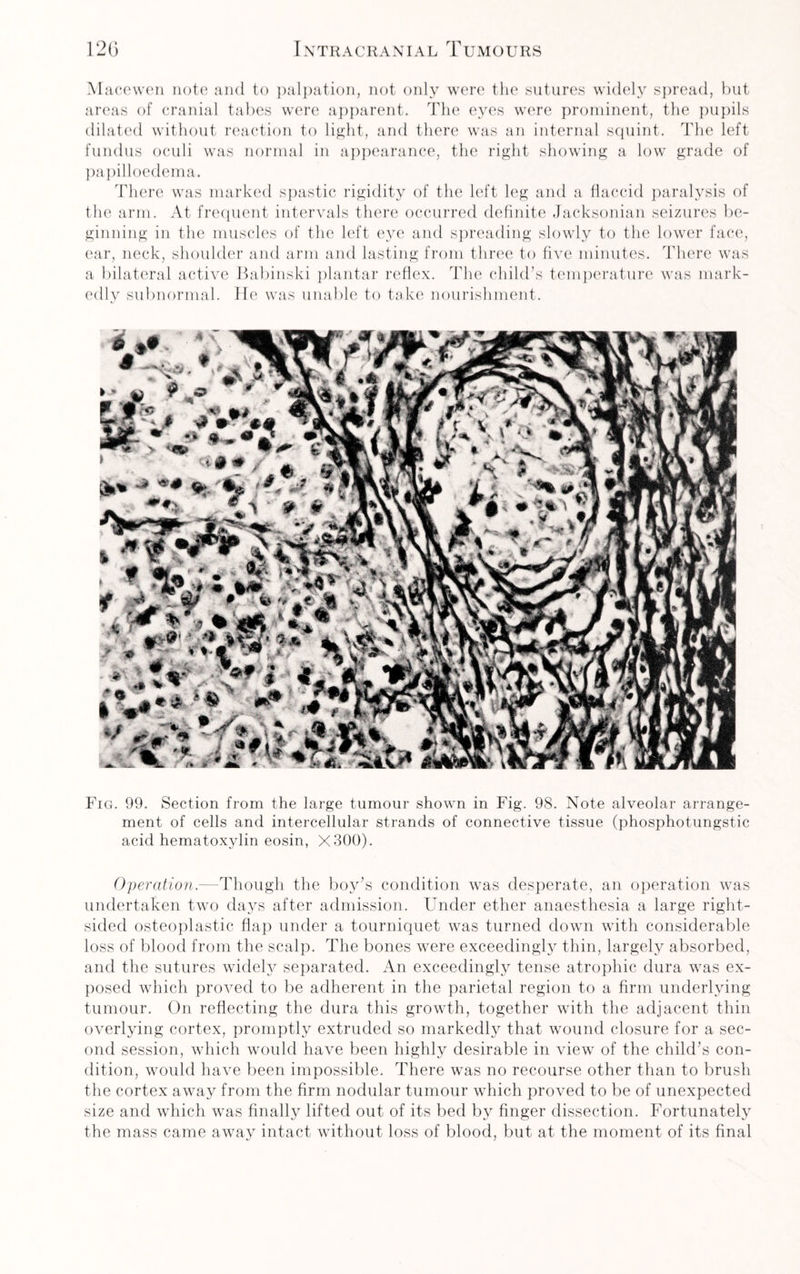 Macewen note and to palpation, not only were the sutures widely spread, but areas of cranial tabes were apparent. The eyes were prominent, the pupils dilated without reaction to light, and there was an internal squint. The left fundus oculi was normal in appearance, the right showing a low grade of papilloedema. There was marked spastic rigidity of the left leg and a flaccid paralysis of the arm. At frequent intervals there occurred definite Jacksonian seizures be¬ ginning in the muscles of the left e,ye and spreading slowly to the lower face, ear, neck, shoulder and arm and lasting from three to five minutes. There was a bilateral active Babinski plantar reflex. The child’s temperature was mark¬ edly subnormal. lie was unable to take nourishment. Fig. 99. Section from the large tumour shown in Fig. 98. Note alveolar arrange¬ ment of cells and intercellular strands of connective tissue (phosphotungstic acid hematoxylin eosin, X300). Operation.—Though the boy’s condition was desperate, an operation was undertaken two days after admission. Under ether anaesthesia a large right¬ sided osteoplastic flap under a tourniquet was turned down with considerable loss of blood from the scalp. The bones were exceedingly thin, largely absorbed, and the sutures widely separated. An exceedingly tense atrophic dura was ex¬ posed which proved to be adherent in the parietal region to a firm underlying tumour. On reflecting the dura this growth, together with the adjacent thin overlying cortex, promptly extruded so markedly that wound closure for a sec¬ ond session, which would have been highly desirable in view of the child’s con¬ dition, would have been impossible. There was no recourse other than to brush the cortex away from the firm nodular tumour which proved to be of unexpected size and which was finally lifted out of its bed by finger dissection. Fortunately the mass came away intact without loss of blood, but at the moment of its final