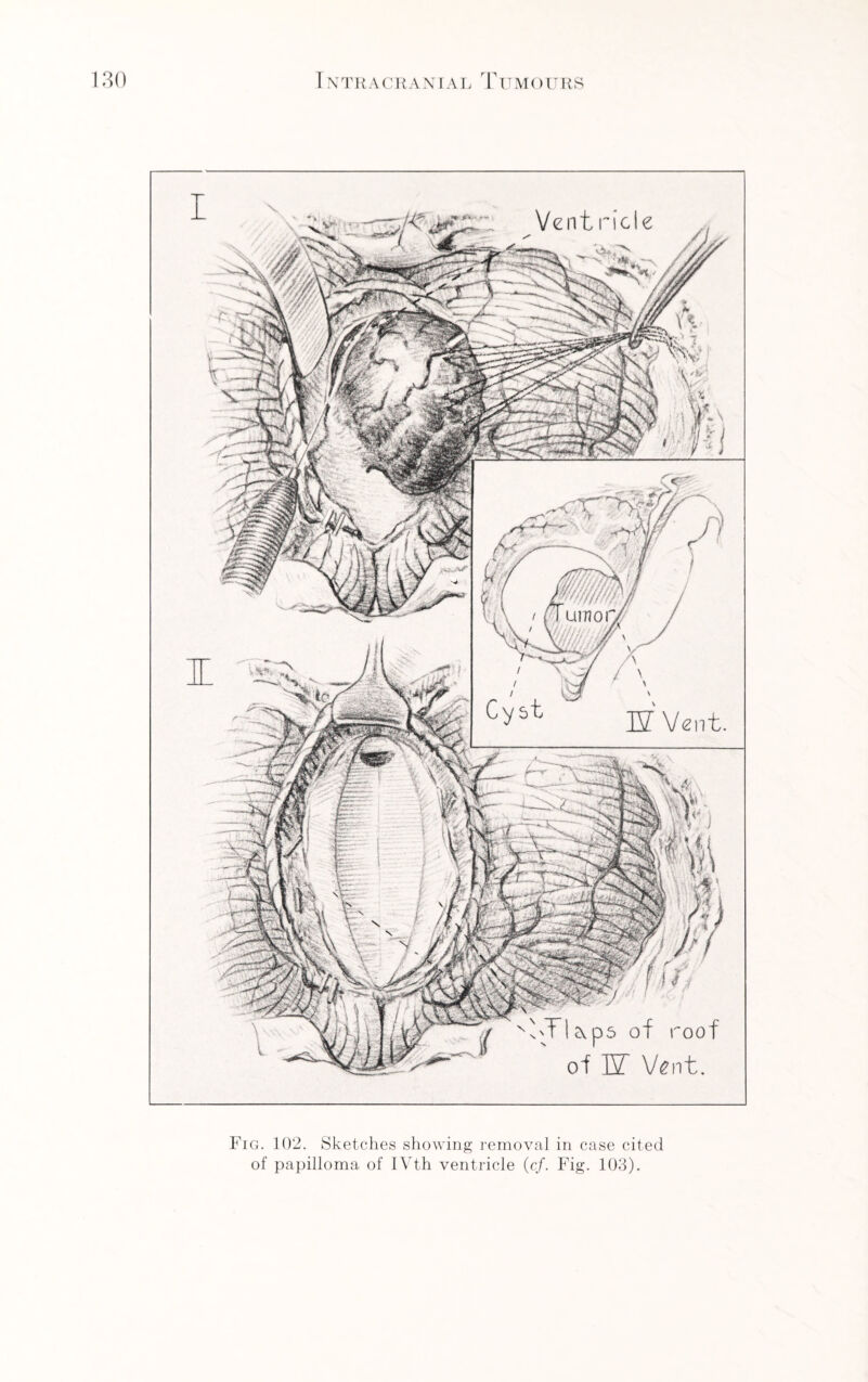 Fig. 102. Sketches showing removal in case cited of papilloma of IVth ventricle (c/. Fig. 103).