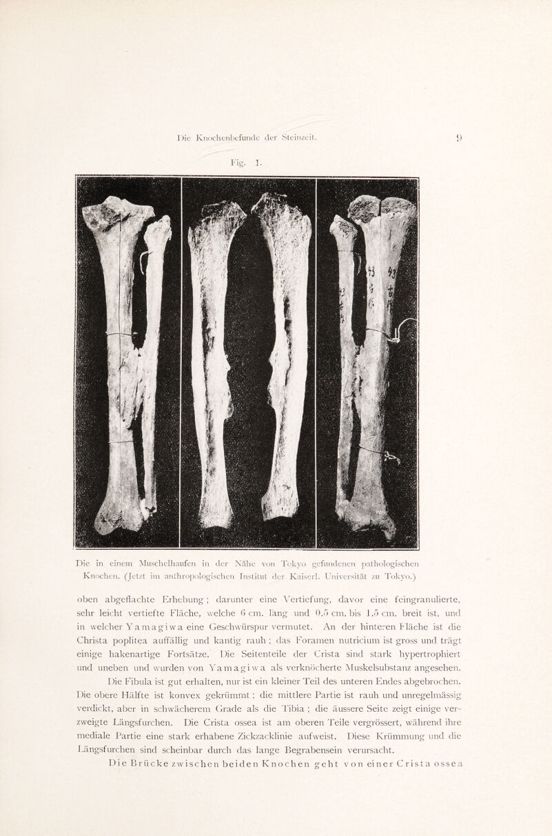 Die in einem Muschelhaufen in der Nähe von Tokyo gefundenen pathologischen Knochen. (Jetzt im anthropologischen Institut der Kaiserl. Universität zu Tokyo.) oben abgeflachte Erhebung; darunter eine Vertiefung, davor eine feingranulierte, sehr leicht vertiefte Fläche, welche 6 cm. lang und 0.5 cm. bis 1.5 cm. breit ist, und in welcher Yamagiwa eine Geschwürspur vermutet. An der hinteren Fläche ist die Christa poplitea auffällig und kantig rauh ; das Foramen nutricium ist gross und trägt einige hakenartige Fortsätze. Die Seitenteile der Crista sind stark hypertrophiert und uneben und wurden von Yamagiwa als verknöcherte Muskelsubstanz angesehen. Die Fibula ist gut erhalten, nur ist ein kleiner Teil des unteren Endes abgebrochen. Die obere Hälfte ist konvex gekrümmt; die mittlere Partie ist rauh und unregelmässig verdickt, aber in schwächerem Grade als die Tibia ; die äussere Seite zeigt einige ver¬ zweigte Längsfurchen. Die Crista ossea ist am oberen Teile vergrössert, während ihre mediale Partie eine stark erhabene Zickzacklinie aufweist. Diese Krümmung und die Längsfurchen sind scheinbar durch das lange Begrabensein verursacht. Die Brücke zwischen beiden Knochen geht von ei n e r Crista ossea