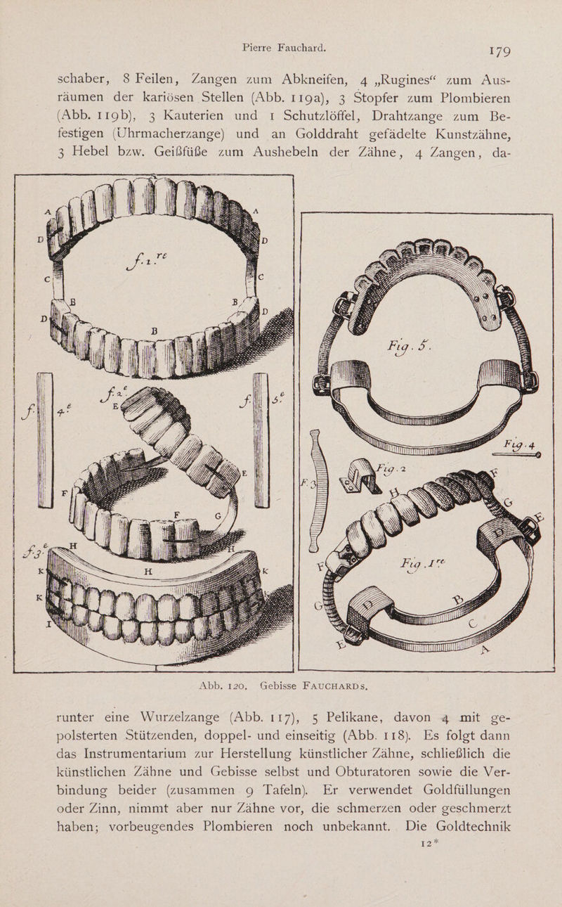 schaber, 8 Feilen, Zangen zum Abkneifen, 4 „Rugines“ zum Aus¬ räumen der kariösen Stellen (Abb. 119a), 3 Stopfer zum Plombieren (Abb. 119b), 3 Kauterien und 1 Schutzlöffel, Drahtzange zum Be¬ festigen (Uhrmacherzange) und an Golddraht gefädelte Kunstzähne, 3 Hebel bzw. Geißfüße zum Aushebeln der Zähne, 4 Zangen, da- Abb. 120. Gebisse Fauchard s. runter eine Wurzelzange (Abb. 117), 5 Pelikane, davon 4 mit ge¬ polsterten Stützenden, doppel- und einseitig (Abb. 118). Es folgt dann das Instrumentarium zur Herstellung künstlicher Zähne, schließlich die künstlichen Zähne und Gebisse selbst und Obturatoren sowie die Ver¬ bindung beider (zusammen 9 Tafeln). Er verwendet Goldfüllungen oder Zinn, nimmt aber nur Zähne vor, die schmerzen oder geschmerzt haben; vorbeugendes Plombieren noch unbekannt. Die Goldtechnik 12*