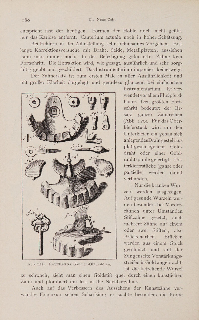 entspricht fast der heutigen. Formen der Höhle noch nicht geübt, nur das Kariöse entfernt. Cauterium actuale noch in hoher Schätzung. Bei Fehlern in der Zahnstellung sehr behutsames Vorgehen. Erst lange Korrektionsversuche mit Draht, Seide, Metallplatten; ausziehen kann man immer noch. In der Befestigung gelockerter Zähne kein Fortschritt. Die Extraktion wird, wie gesagt, ausführlich und sehr sorg¬ fältig geübt und geschildert. Das Instrumentarium imponiert keineswegs. Der Zahnersatz ist zum ersten Male in allef Ausführlichkeit und mit großer Klarheit dargelegt und geradezu glänzend bei einfachstem Instrumentarium. Er ver¬ wendet vor allem Flußpferd¬ hauer. Den größten Fort¬ schritt bedeutet der Er¬ satz ganzer Zahnreihen (Abb. 120). Für das Ober¬ kieferstück wird um den Unterkiefer ein genau sich anlegendesDrahtgestell aus plattgeschlagenem Gold¬ draht oder einer Gold¬ drahtspirale gefertigt. Un¬ terkieferstücke (ganze oder partielle) werden damit verbunden. Nur die kranken Wur¬ zeln werden ausgezogen. Auf gesunde Wurzeln wer¬ den besonders bei Vorder¬ zähnen unter Umständen Stiftzähne gesetzt, auch mehrere Zähne auf einem oder zwei Stiften, also Brückenarbeit. Brücken werden aus einem iStück geschnitzt und auf der Zungenseite Verstärkungs- Abb. 121. Fauchards Gaumen-Obturatoren. Streifen in Gold angebracht. Ist die betreffende Wurzel zu schwach, zieht man einen Goldstift quer durch einen künstlichen Zahn und plombiert ihn fest in die Nachbarzähne. Auch auf das Verbessern des Aussehens der Kunstzähne ver¬ wandte Fauchard seinen Scharfsinn; er suchte besonders die Farbe