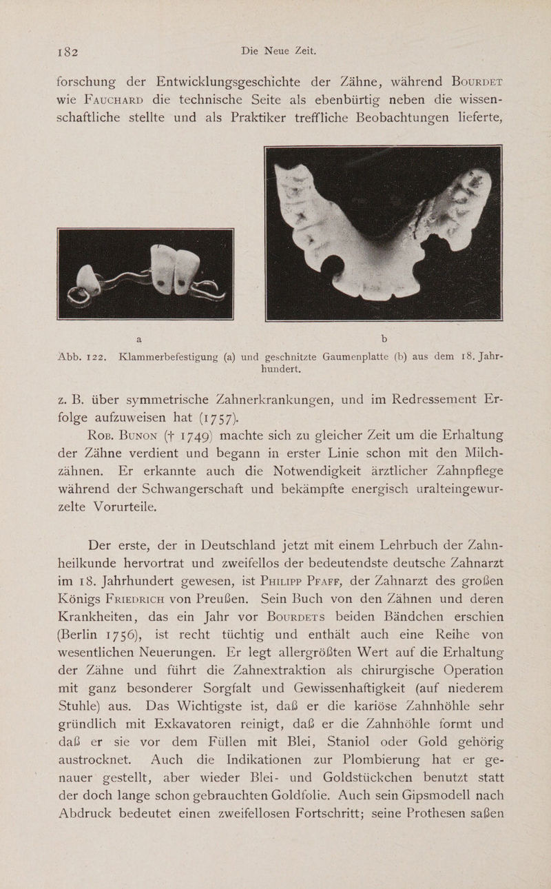 forschung der Entwicklungsgeschichte der Zähne, während Bourdet wie Fauchard die technische Seite als ebenbürtig neben die wissen¬ schaftliche stellte und als Praktiker treffliche Beobachtungen lieferte, a b Abb. 122. Klammerbefestigung (a) und geschnitzte Gaumenplatte (b) aus dem 18. Jahr¬ hundert. z. B. über symmetrische Zahnerkrankungen, und im Redressement Er¬ folge aufzuweisen hat (1757). Rob. Bunon (f 1749) machte sich zu gleicher Zeit um die Erhaltung der Zähne verdient und begann in erster Linie schon mit den Milch- zähnen. Er erkannte auch die Notwendigkeit ärztlicher Zahnpflege während der Schwangerschaft und bekämpfte energisch uralteingewur¬ zelte Vorurteile. Der erste, der in Deutschland jetzt mit einem Lehrbuch der Zahn¬ heilkunde hervortrat und zweifellos der bedeutendste deutsche Zahnarzt im 18. Jahrhundert gewesen, ist Philipp Pfaff, der Zahnarzt des großen Königs Friedrich von Preußen. Sein Buch von den Zähnen und deren Krankheiten, das ein Jahr vor Bourdets beiden Bändchen erschien (Berlin 1756), ist recht tüchtig und enthält auch eine Reihe von wesentlichen Neuerungen. Er legt allergrößten Wert auf die Erhaltung der Zähne und führt die Zahnextraktion als chirurgische Operation mit ganz besonderer Sorgfalt und Gewissenhaftigkeit (auf niederem Stuhle) aus. Das Wichtigste ist, daß er die kariöse Zahnhöhle sehr gründlich mit Exkavatoren reinigt, daß er die Zahnhöhle formt und daß er sie vor dem Füllen mit Blei, Staniol oder Gold gehörig austrocknet. Auch die Indikationen zur Plombierung hat er ge¬ nauer gestellt, aber wieder Blei- und Goldstückchen benutzt statt der doch lange schon gebrauchten Goldfolie. Auch sein Gipsmodell nach Abdruck bedeutet einen zweifellosen Fortschritt; seine Prothesen saßen
