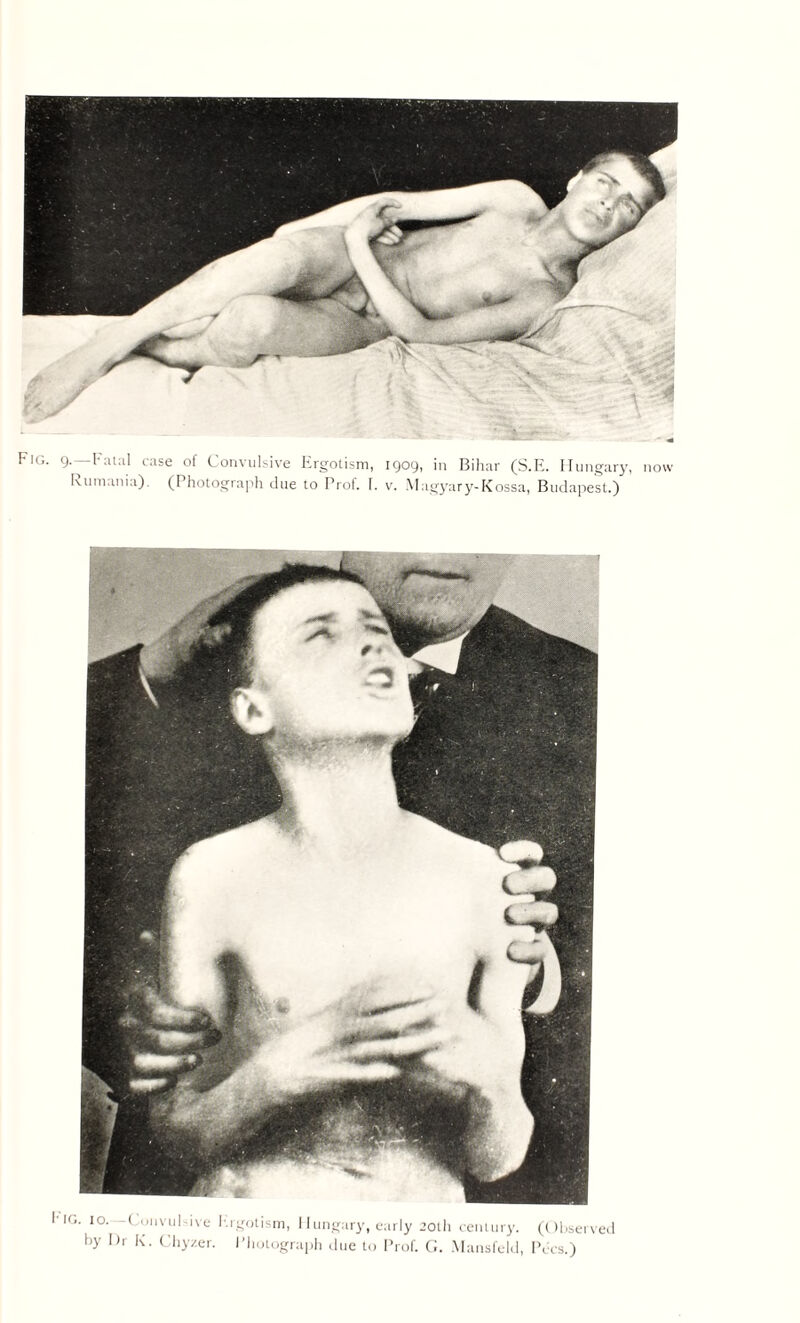 Fig. 9.—Fatal case of Convulsive Ergotism, 1909, in Bihar (S.E. Hungary, now ig. 10. ( onvulsive Ergotism, Hungary, early 20th century. (Observed by I)r K. Chyzer. Photograph due to Prof. G. Mansfeld, Pecs.) \\V