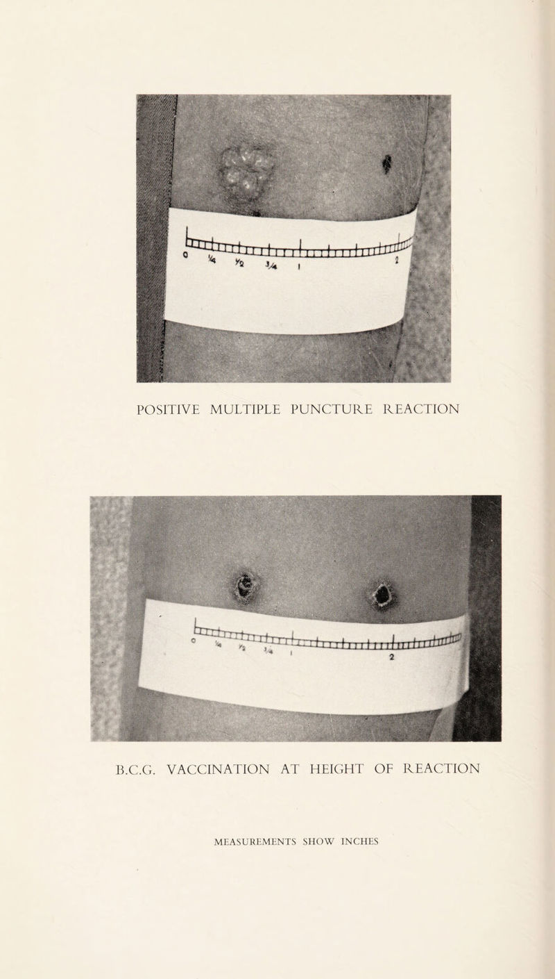 POSITIVE MULTIPLE PUNCTURE REACTION B.C.G. VACCINATION AT HEIGHT OF REACTION MEASUREMENTS SHOW INCHES