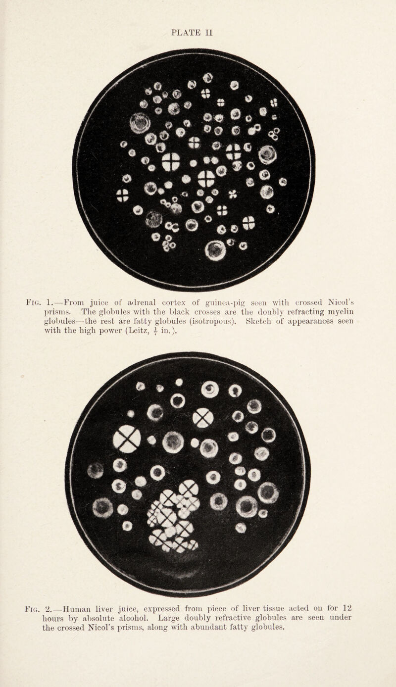 PLATE II Fig. 1.—From juice of adrenal cortex of guinea-pig seen with crossed Nicol’s prisms. The globules with the black crosses are the doubly refracting myelin globules—the rest are fatty globules (isotropous). Sketch of appearances seen with the high power (Leitz, \ in.). Fig. 2.—Human liver juice, expressed from piece of liver tissue acted on for 12 hours by absolute alcohol. Large doubly refractive globules are seen under the crossed Nicol’s prisms, along with abundant fatty globules.