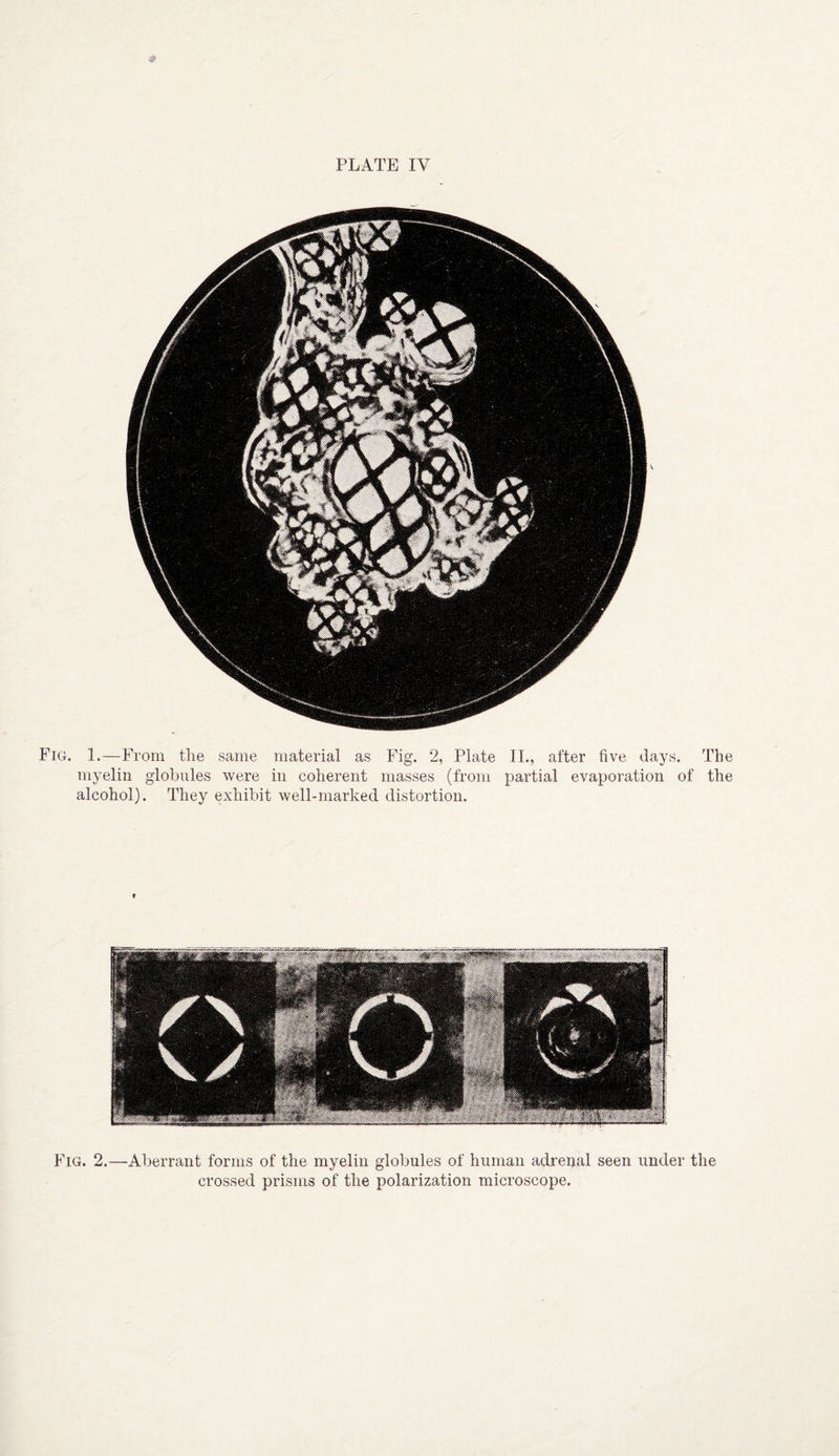 Fig. 1.—From the same material as Fig. 2, Plate II., after five days. The myelin globules were in coherent masses (from partial evaporation of the alcohol). They exhibit well-marked distortion. Fig. 2.—Aberrant forms of the myelin globules of human adrenal seen under the crossed prisms of the polarization microscope.