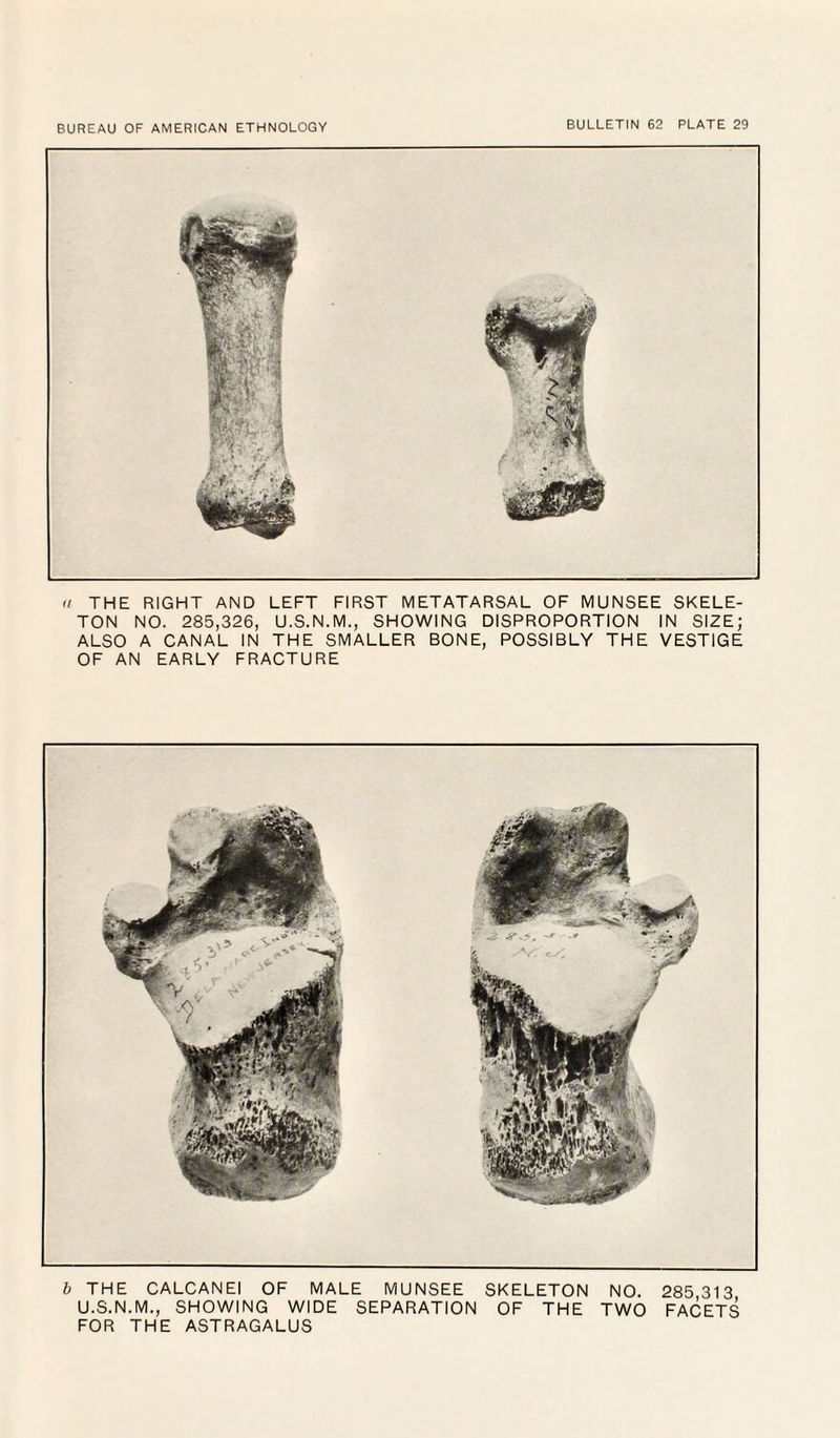 (i THE RIGHT AND LEFT FIRST METATARSAL OF MUNSEE SKELE¬ TON NO. 285,326, U.S.N.M., SHOWING DISPROPORTION IN SIZE; ALSO A CANAL IN THE SMALLER BONE, POSSIBLY THE VESTIGE OF AN EARLY FRACTURE b THE CALCANEI OF MALE MUNSEE SKELETON NO. 285 313 U.S.N.M., SHOWING WIDE SEPARATION OF THE TWO FACETS FOR THE ASTRAGALUS