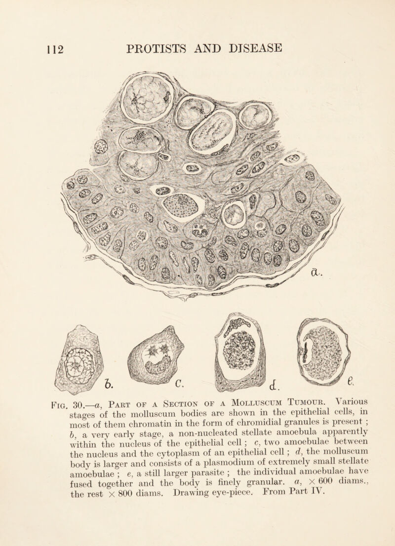 Fig 30._a Part of a Section of a Molluscum Tumour. A arious ' stages of the molluscum bodies are shown in the epithelial cells, in most of them chromatin in the form of chromidial granules is present , b, a very early stage, a non-nucleated stellate amoebula apparently within the nucleus of the epithelial cell ; c, two amoebulae between the nucleus and the cytoplasm of an epithelial cell ; d, the molluscum body is larger and consists of a plasmodium of extremely small stellate amoebulae ; e, a still larger parasite ; the individual amoebulae have fused together and the body is finely granular, a, X 600 diams., the rest X 800 diams. Drawing eye-piece. From Part IV.