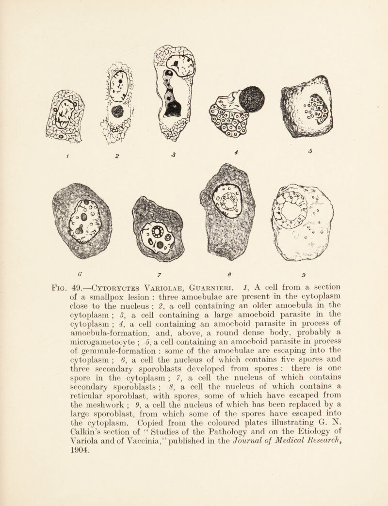 Fig. 49.—Cytoryctes Variolae, Guarnieri. 2, A cell from a section of a smallpox lesion : three amoebnlae are present in the cytoplasm close to the nucleus ; 2, a cell containing an older amoebula in the cytoplasm ; 3, a cell containing a large amoeboid parasite in the cytoplasm ; 4, a cell containing an amoeboid parasite in process of amoebula-formation, and, above, a round dense body, probably a microgametocyte ; 3, a cell containing an amoeboid parasite in process of gemmule-formation : some of the amoebulae are escaping into the cytoplasm ; 6, a cell the nucleus of which contains five spores and three secondary sporoblasts developed from spores : there is one spore in the cytoplasm ; 7, a cell the nucleus of which contains secondary sporoblasts ; 8, a cell the nucleus of which contains a reticular sporoblast, with spores, some of which have escaped from the meshwork ; 9, a cell the nucleus of which has been replaced by a large sporoblast, from which some of the spores have escaped into the cytoplasm. Copied from the coloured plates illustrating G. N. Calkin’s section of “ Studies of the Pathology and on the Etiology of Variola and of Vaccinia,” published in the Journal of Medical Research, 1904.