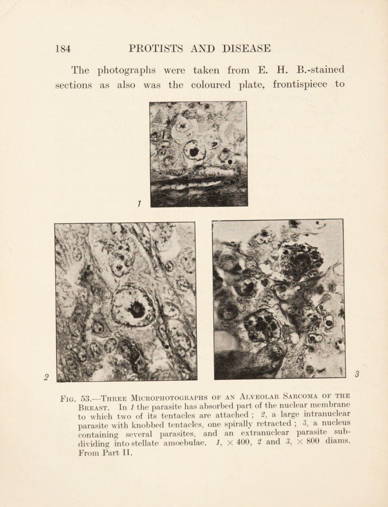 The photographs were taken from E. sections as also was the coloured plate, H. B.-stained frontispiece to Fig. 53._Three Microphotographs of an Alveolar Sarcoma of the Breast. In 1 the parasite has absorbed part of the nuclear membrane to which two of its tentacles are attached ; 2, a large intranuclear parasite with knobbed tentacles, one spirally retracted , 3, a nucleus containing several parasites, and an extranuclear parasite sub¬ dividing into stellate amoebulae. 1, X 400, 2 and 3, x 800 diams. From Part II.