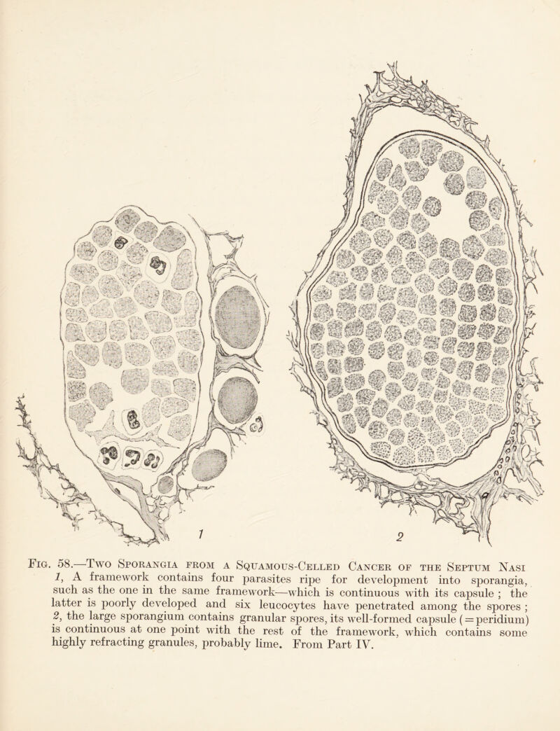 Fig. 58. -Two Sporangia from a Sqfamous-Celled Cancer of the Septum Nasi 1, A framework contains four parasites ripe for development into sporangia, such as the one in the same framework—which is continuous with its capsule ; the latter is poorly developed and six leucocytes have penetrated among the spores ; 2, the large sporangium contains granular spores, its well-formed capsule (= peridium) is continuous at one point with the rest of the framework, which contains some