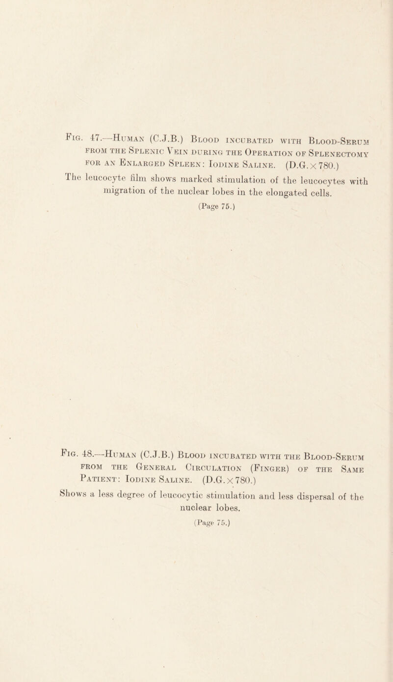 Fig. 47.—Human (C.J.B.) Blood incubated with Blood-Serum from the Splenic A ein during the Operation of Splenectomy for an Enlarged Spleen: Iodine Saline. (D.G.X780.) The leucocyte film shows marked stimulation of the leucocytes with migration of the nuclear lobes in the elongated cells. (Page 75.) Fig. 48.—•Human (C.J.B.) Blood incubated with the Blood-Serum from the General Circulation (Finger) of the Same Patient: Iodine Saline. (D.G.X780.) Shows a less degree of leucocytic stimulation and less dispersal of the nuclear lobes.