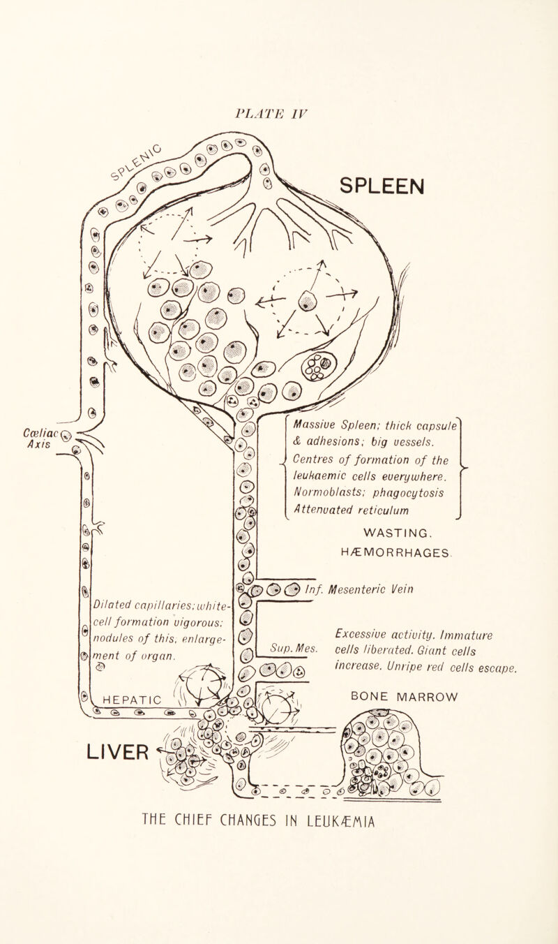 PLATE IV SPLEEN CmliacQ, Ax's off Dilated capillaries;white- cell formation vigorous; nodules of this, enlarge¬ ment of organ. Massive Spleen; thick capsule & adhesions; big vessels. Centres of formation of the i leu haem ic cells everywhere. Normoblasts; phagocytosis Attenvated reticulum WASTING. H/EMORRHAGES. {•y$/  1 11 1 1 mm ® O Inf Mesenteric Vein Excessive activity. Immature Sup^Mes. cells liberated. Giant cells increase. Unripe red cells escape. BONE MARROW LIVER THE CHIEF CHANGES IN LEUKEMIA