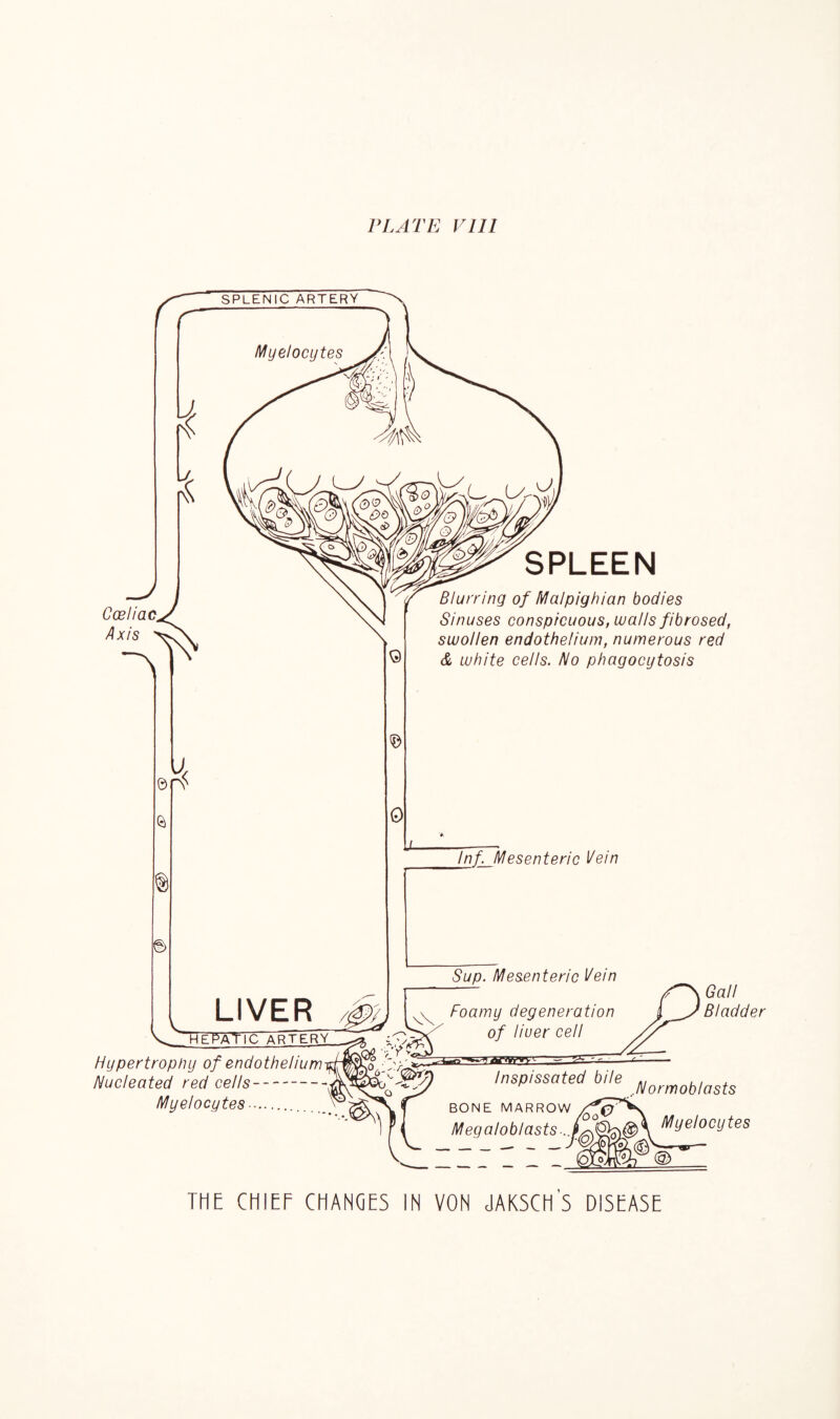 PLATE VIII SPLENIC ARTERY i & Coeliac^J Axis ©rv a © Myelocytes LIVER © 0 SPLEEN Blurring of Malpighian bodies Sinuses conspicuous, walls fibrosed, swollen endothelium, numerous red & white cells. No phagocytosis lnf_Mesenteric l/ein hepaticarterv Hypertrophy of endothelium Nucleated red cells Myelocytes- Sup. Mesenteric l/ein Foamy degeneration of liuer cell Gall Bladder Inspissated bile BONE MARROW Megaloblasts... Normoblasts Myelocytes THE CHIEF CHANCES IN VON JAKSCHS DISEASE