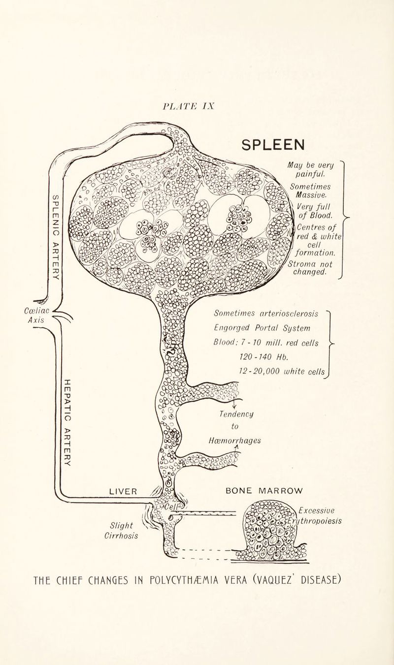 May be uery painful. Sometimes Massive. Very full of Blood. \ Centres of red & white cell formation. > changed. J Sometimes arteriosclerosis Engorged Porta! System Blood; 7 - 70 mill, red cells 120-740 Hb. 72-20,000 white cells y Slight Cirrhosis Excessive Erythropoiesis THE CHIEF CHANGES IN POLYCYTH/EMIA VERA (VAQUEZ' DISEASE)