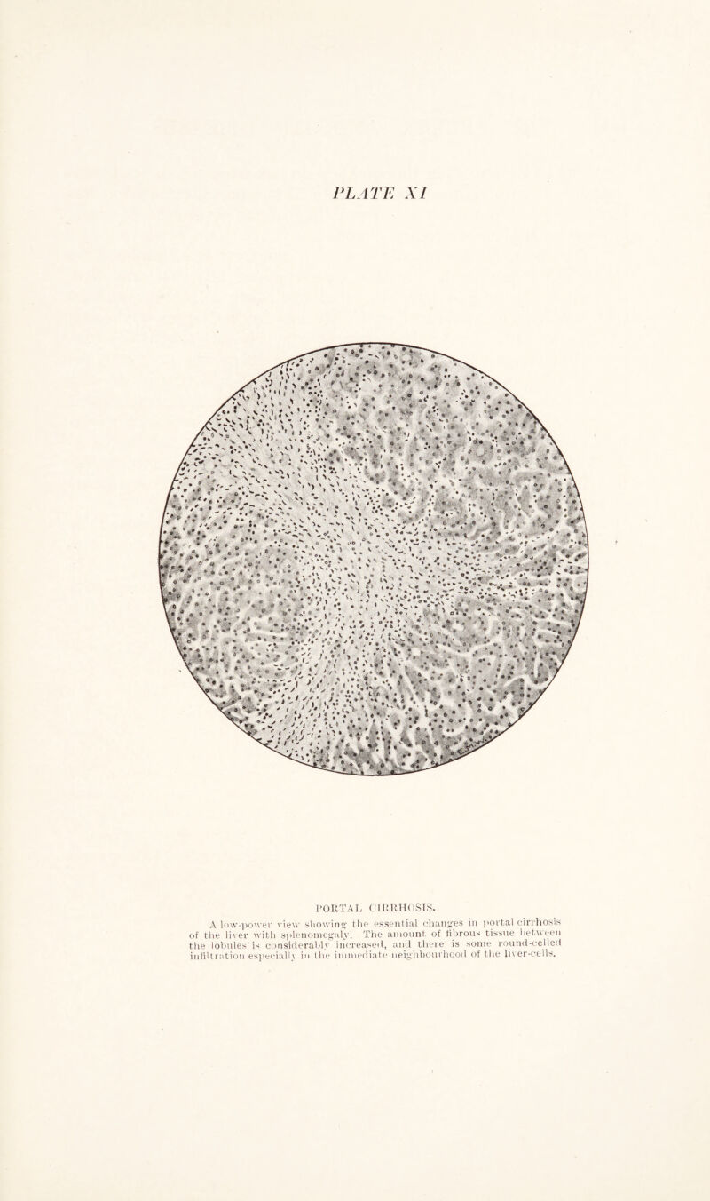 PORTAL CIRRHOSIS. A low-power view showing the essential changes in portal cirrhosis of the liver with splenomegaly. The amount of fibrous tissue between the lobules is considerably increased, and there is some round-celled infiltration especially in the immediate neighbourhood of the liver-cells.