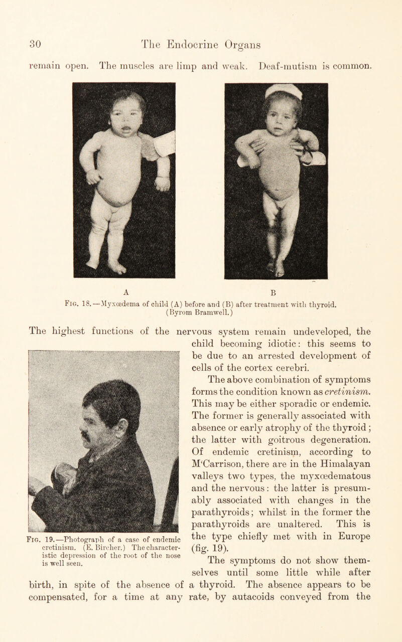 O remain open. The muscles are limp and weak. Deaf-mutism is common. A B Fig. 18. — Myxcedema of child (A) before and (B) after treatment with thyroid. (Byrom Bramwell.) The highest functions of the nervous system remain undeveloped, the Fig, 19.—Photograph of a case of endemic cretinism. (E. Bircher.) The character¬ istic depression of the root of the nose is well seen. birth, in spite of the absence of compensated, for a time at any child becoming idiotic: this seems to be due to an arrested development of cells of the cortex cerebri. The above combination of symptoms forms the condition known as cretinism. This may be either sporadic or endemic. The former is generally associated with absence or early atrophy of the thyroid ; the latter with goitrous degeneration. Of endemic cretinism, according to M‘Carrison, there are in the Himalayan valleys two types, the myxoedematous and the nervous: the latter is presum¬ ably associated with changes in the parathyroids; whilst in the former the parathyroids are unaltered. This is the type chiefly met with in Europe (fig. 19). The symptoms do not show them¬ selves until some little while after a thyroid. The absence appears to be rate, by autacoids conveyed from the