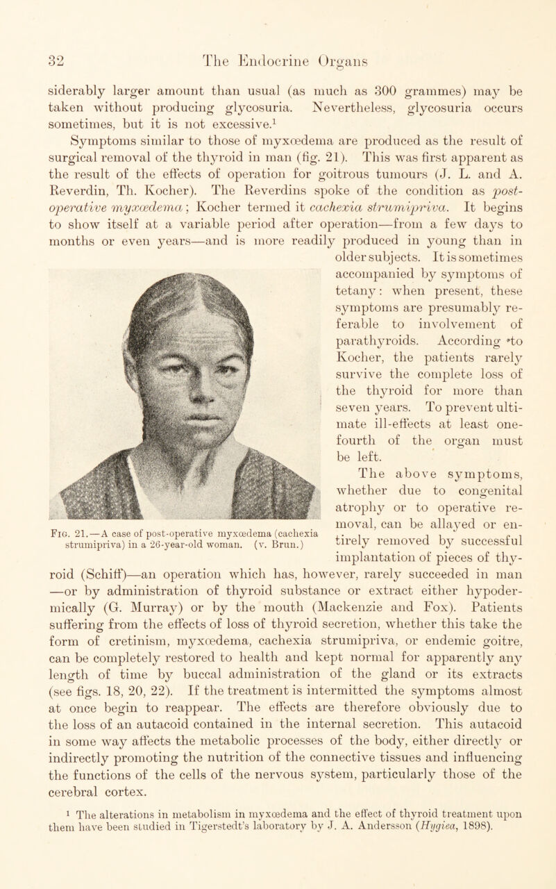 siderably larger amount than usual (as much as 300 grammes) may be taken without producing glycosuria. Nevertheless, glycosuria occurs sometimes, but it is not excessive.1 Symptoms similar to those of myxoedema are produced as the result of surgical removal of the thyroid in man (fig. 21). This was first apparent as the result of the effects of operation for goitrous tumours (J. L. and A. Reverdin, Th. Kocher). The Reverdins spoke of the condition as 'post¬ operative myxoedema; Kocher termed it cachexia strumipriva. It begins to show itself at a variable period after operation—from a few days to months or even years—and is more readily produced in young than in older subjects. It is sometimes accompanied by symptoms of tetany: when present, these symptoms are presumably re¬ ferable to involvement of parathyroids. According To Kocher, the patients rarely survive the complete loss of the thyroid for more than seven years. To prevent ulti¬ mate ill-effects at least one- fourth of the organ must be left. The above symptoms, whether due to congenital © atrophy or to operative re¬ moval, can be allayed or en¬ tirely removed by successful implantation of pieces of thy¬ roid (Schiff)—an operation which has, however, rarely succeeded in man —or by administration of thyroid substance or extract either hypoder¬ mically (G. Murray) or by the mouth (Mackenzie and Fox). Patients suffering from the effects of loss of thyroid secretion, whether this take the form of cretinism, myxoedema, cachexia strumipriva, or endemic goitre, can be completely restored to health and kept normal for apparently any length of time by buccal administration of the gland or its extracts (see figs. 18, 20, 22). If the treatment is intermitted the symptoms almost at once begin to reappear. The effects are therefore obviously due to the loss of an autacoid contained in the internal secretion. This autacoid in some way affects the metabolic processes of the body, either directly or indirectly promoting the nutrition of the connective tissues and influencing the functions of the cells of the nervous system, particularly those of the cerebral cortex. 1 The alterations in metabolism in myxoedema and the effect of thyroid treatment upon them have been studied in Tigerstedt’s laboratory by J. A. Andersson (Hygiea, 1898). Fig. 21. — A case of post-operative myxoedema (cachexia strumipriva) in a 26-year-old woman, (v. Brun.)