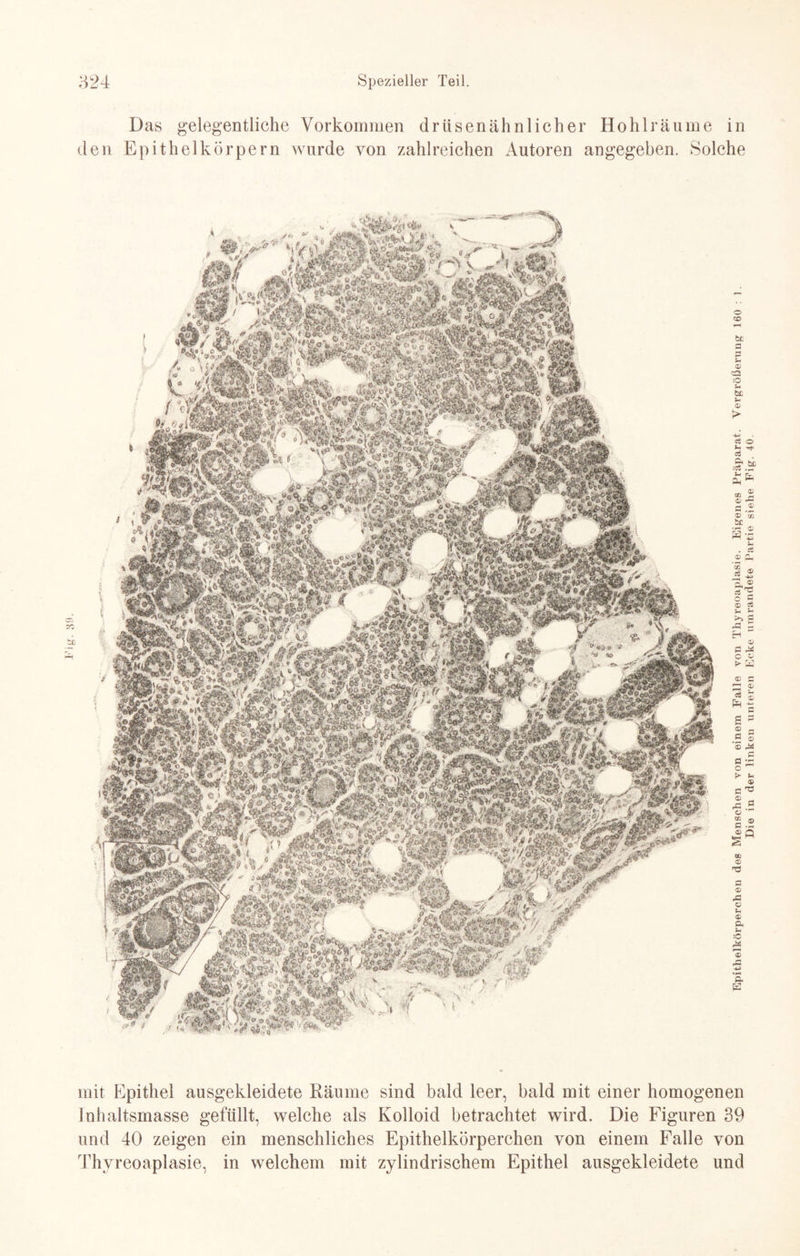 Das gelegentliche Vorkommen drtisenähnlicher Hohlräume in den Epithel körpern wurde von zahlreichen Autoren angegeben. Solche mit Epithel ausgekleidete Räume sind bald leer, bald mit einer homogenen Inhaltsmasse gefüllt, welche als Kolloid betrachtet wird. Die Figuren 39 und 40 zeigen ein menschliches Epithelkörperchen von einem Falle von Thyreoaplasie, in welchem mit zylindrischem Epithel ausgekleidete und