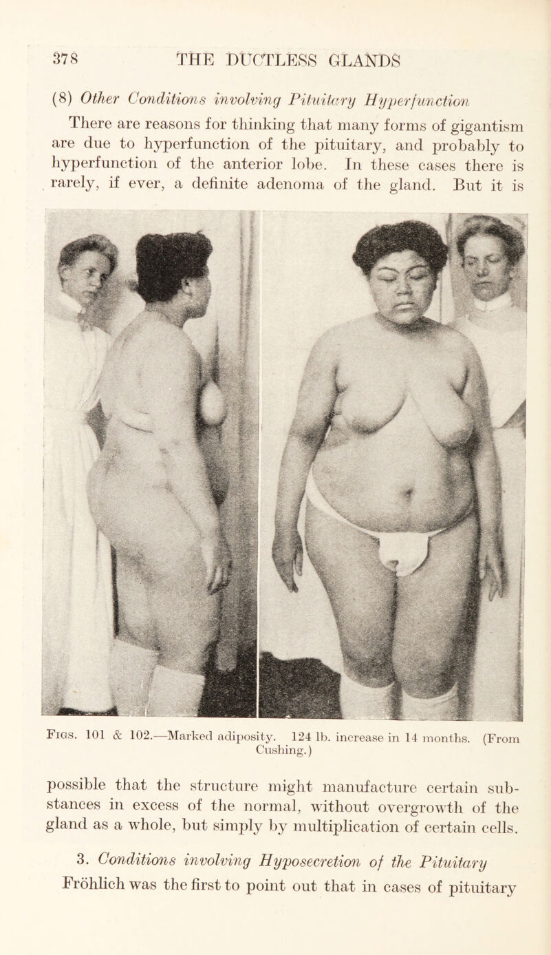 (8) Other Conditions involving Pituitary Hyper function There are reasons for thinking that many forms of gigantism are due to hyperfunction of the pituitary, and probably to hyperfunction of the anterior lobe. In these cases there is rarely, if ever, a definite adenoma of the gland. But it is Figs. 101 & 102.—Marked adiposity. 124 lb. increase in 14 months. (From Cushing.) possible that the structure might manufacture certain sub¬ stances in excess of the normal, without overgrowth of the gland as a whole, but simply by multiplication of certain cells. 3. Conditions involving Hyposecretion of the Pituitary Frohlich was the first to point out that in cases of pituitary