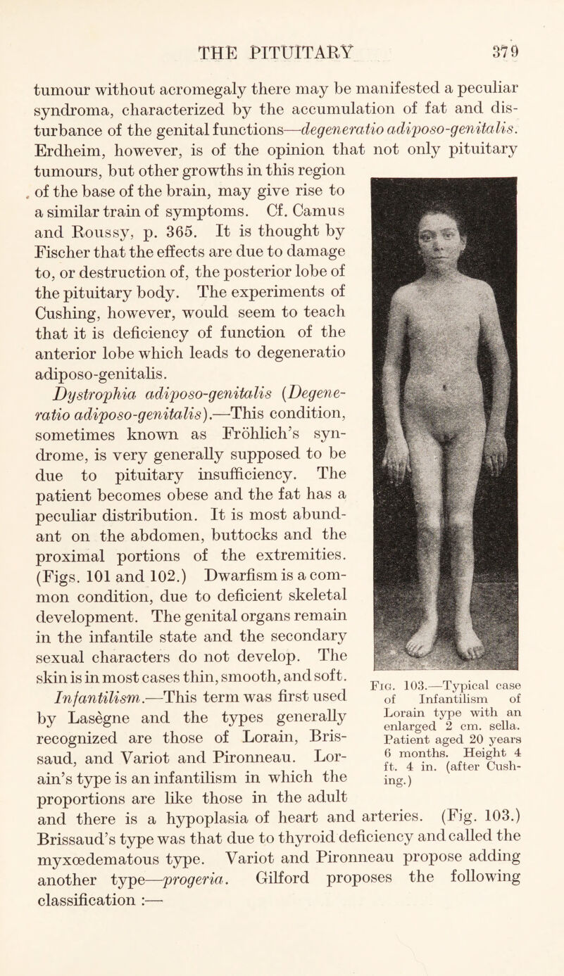 tumour without acromegaly there may be manifested a peculiar syndroma, characterized by the accumulation of fat and dis¬ turbance of the genital functions—deg eneratio adiposo-genitalis. Erdheim, however, is of the opinion that not only pituitary tumours, but other growths in this region , of the base of the brain, may give rise to a similar train of symptoms. Cf. Camus and Roussy, p. 365. It is thought by Fischer that the effects are due to damage to, or destruction of, the posterior lobe of the pituitary body. The experiments of Cushing, however, would seem to teach that it is deficiency of function of the anterior lobe which leads to degeneratio adiposo-genitalis. Dystrophia adiposo-genitalis (Degene¬ ratio adiposo-genitalis).—This condition, sometimes known as Frohlich’s syn¬ drome, is very generally supposed to be due to pituitary insufficiency. The patient becomes obese and the fat has a peculiar distribution. It is most abund¬ ant on the abdomen, buttocks and the proximal portions of the extremities. (Figs. 101 and 102.) Dwarfism is a com¬ mon condition, due to deficient skeletal development. The genital organs remain in the infantile state and the secondary sexual characters do not develop. The skin is in most cases thin, smooth, and soft. Infantilism.—This term was first used by Lasegne and the types generally recognized are those of Lorain, Bris- saud, and Variot and Pironneau. Lor¬ ain’s type is an infantilism in which the proportions are like those in the adult and there is a hypoplasia of heart and arteries. (Fig. 103.) Brissaud’s type was that due to thyroid deficiency and called the myxoedematous type. Variot and Pironneau propose adding another type—progeria. Gilford proposes the following classification :— Fig. 103.—Typical case of Infantilism of Lorain type with an enlarged 2 cm. sella. Patient aged 20 years 6 months. Height 4 ft. 4 in. (after Cush¬ ing.)