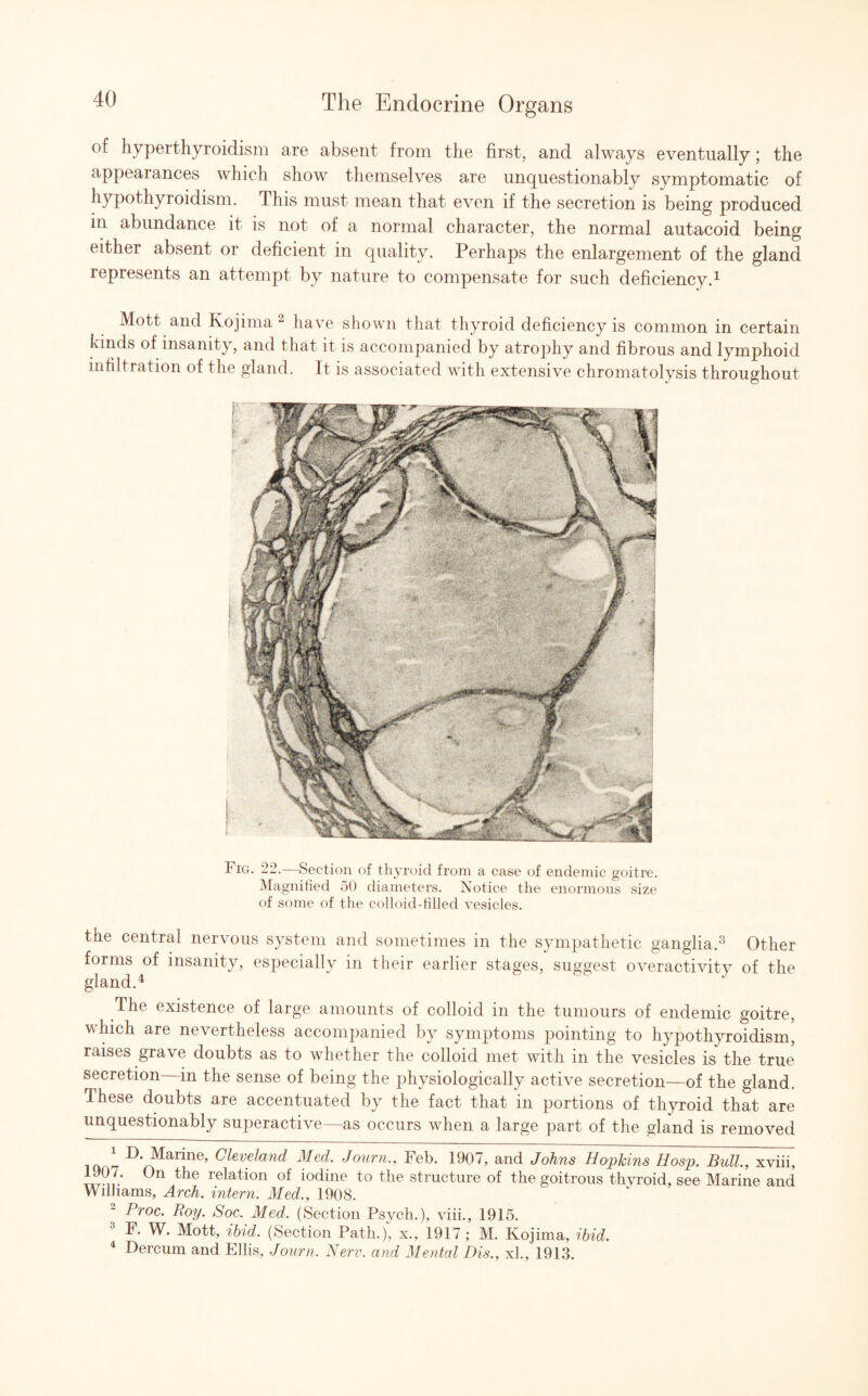 of hyperthyroidism are absent from the first, and always eventually; the appearances which show themselves are unquestionably symptomatic of hypothyroidism. This must mean that even if the secretion is being produced in abundance it is not of a normal character, the normal autacoid being either absent or deficient in quality. Perhaps the enlargement of the gland represents an attempt by nature to compensate for such deficiency.1 Mott and Kojima 2 have shown that thyroid deficiency is common in certain kinds of insanity, and that it is accompanied by atrophy and fibrous and lymphoid infiltration of the gland. It is associated with extensive chromatolysis throughout the central nervous system and sometimes in the sympathetic ganglia.3 Other forms of insanity, especially in their earlier stages, suggest overactivity of the gland.4 The existence of large amounts of colloid in the tumours of endemic goitre, which are nevertheless accompanied by symptoms pointing to hypothyroidism, raises grave doubts as to whether the colloid met with in the vesicles is the true secretion in the sense of being the physiologically active secretion—of the gland. These doubts are accentuated by the fact that in portions of thyroid that are unquestionably superactive—as occurs when a large part of the gland is removed 1 P- Marine, Cleveland Med. Journ., Feb. 1907, and Johns Hopkins Hosp. Bull., xviii, 0n the relation of iodine to the structure of the goitrous thyroid, see Marine and Williams, Arch, intern. Med,, 1908. 2 Proc. Boy. Soc. Med, (Section Psych.), viii., 1915. 3 F. W. Mott, ibid, (Section Path.)', x., 1917; M. Kojima, ibid. 4 Dercum and Ellis, Journ. Nerv. and Mental Dis., xl., 1913.