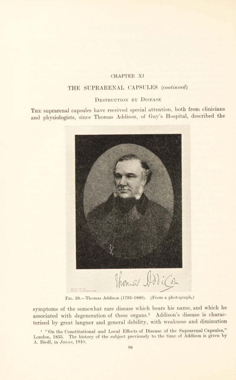 CHAPTER XI THE SUPRARENAL CAPSULES (continued) Destruction by Disease The suprarenal capsules have received special attention, both from clinicians and physiologists, since Thomas Addison, of Guy s Hospital, described the Fig. 59.—Thomas Addison (1793-1860). (From a photograph.) symptoms of the somewhat rare disease which bears his name, and which he associated with degeneration of these organs.1 Addison s disease is charac¬ terised by great languor and general debility, with weakness and diminution 1 “ On the Constitutional and Local Effects of Disease of the Suprarenal Capsules, London, 1855. The history of the subject previously to the time of Addison is given by A. Biedl, in Janus, 1910.