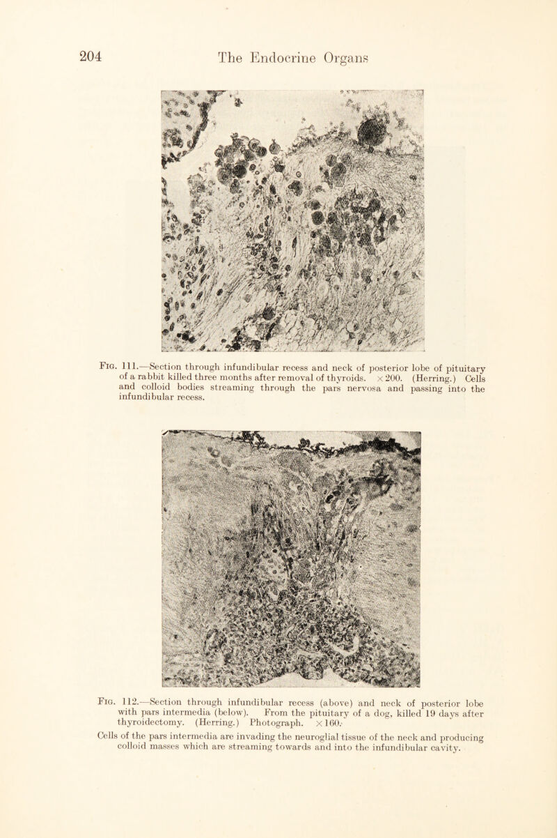 Fig. 111.—Section through infundibular recess and neck of posterior lobe of pituitary of a rabbit killed three months after removal of thyroids. X 200. (Herring.) Cells and colloid bodies streaming through the pars nervosa and passing into the infundibular recess. Fig. 112. Section through infundibular recess (above) and neck of posterior lobe with pars intermedia (below). From the pituitary of a dog, killed 19 days after thyroidectomy. (Herring.) Photograph. Xl60.- Cells of the pars intermedia are invading the neuroglial tissue of the neck and producing colloid masses which are streaming towards and into the infundibular cavity.