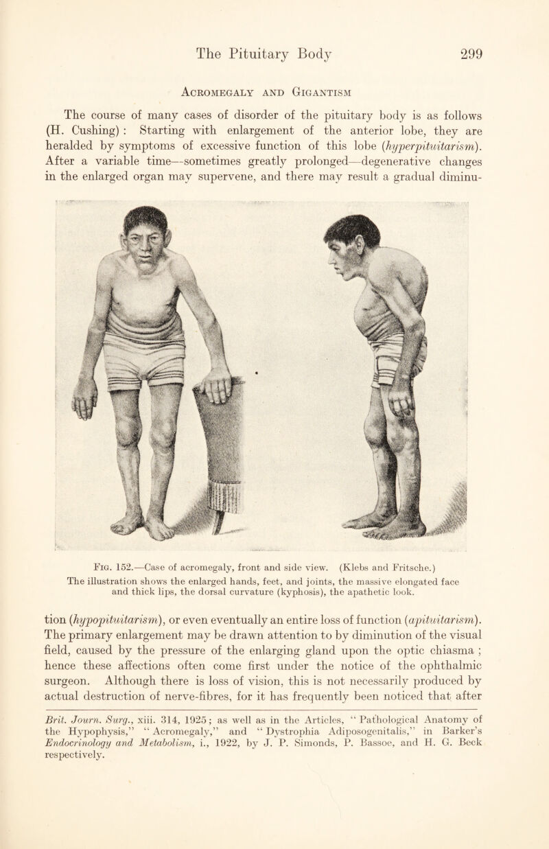 Acromegaly and Gigantism The course of many cases of disorder of the pituitary body is as follows (H. Cushing) : Starting with enlargement of the anterior lobe, they are heralded by symptoms of excessive function of this lobe {hyperpituitarism). After a variable time—sometimes greatly prolonged—degenerative changes in the enlarged organ may supervene, and there may result a gradual diminu- Fig. 152.—Case of acromegaly, front and side view. (Klebs and Fritsche.) The illustration shows the enlarged hands, feet, and joints, the massive elongated face and thick lips, the dorsal curvature (kyphosis), the apathetic look. tion {hypopituitarism), or even eventually an entire loss of function {apituitarism). The primary enlargement may be drawn attention to by diminution of the visual field, caused by the pressure of the enlarging gland upon the optic chiasma ; hence these affections often come first under the notice of the ophthalmic surgeon. Although there is loss of vision, this is not necessarily produced by actual destruction of nerve-fibres, for it has frequently been noticed that after Brit. Journ. Surg., xiii. 314, 1925; as well as in the Articles, “Pathological Anatomy of the Hypophysis,” “ Aeromegaly,” and “ Dystrophia Adiposogenitalis,” in Barker’s Endocrinology and Metabolism, i., 1922, by J. P. Simonds, P. Bassoe, and H. G. Beck respectively.