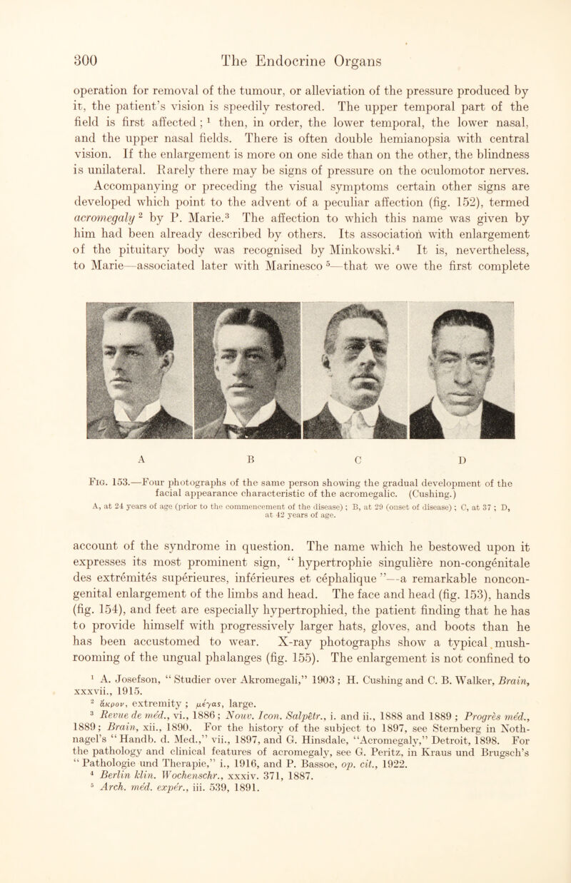 operation for removal of the tumour, or alleviation of the pressure produced by it, the patient’s vision is speedily restored. The upper temporal part of the field is first affected ; ^ then, in order, the lower temporal, the lower nasal, and the upper nasal fields. There is often double hemianopsia with central vision. If the enlargement is more on one side than on the other, the blindness is unilateral. Rarely there may be signs of pressure on the oculomotor nerves. Accompanying or preceding the visual symptoms certain other signs are developed which point to the advent of a peculiar affection (fig. 152), termed acrojnegaly ^ by P. Marie.^ The affection to which this name was given by him had been already described by others. Its association with enlargement of the pituitary body was recognised by Minkowski.^ It is, nevertheless, to Marie—associated later with Marinesco ^—that we owe the first complete ABC D Fig. 153.—Four photograjihs of the same person showing the gradual development of the facial ajipearance characteristic of the acromegalic. (Cushing.) A, at 24 years of age (prior to the commencement of the disease) ; B, at 29 (onset of disease) ; C, at 37 ; D, at 42 years of age. account of the syndrome in question. The name which he bestowed upon it expresses its most prominent sign, “ hypertrophie singuliere non-congenitale des extremites superieures, inferieures et cephalique ”—a remarkable noncon- genital enlargement of the limbs and head. The face and head (fig. 153), hands (fig. 154), and feet are especially hypertrophied, the patient finding that he has to provide himself with progressively larger hats, gloves, and boots than he has been accustomed to wear. X-ray photographs show a typical,mush¬ rooming of the ungual phalanges (fig. 155). The enlargement is not confined to ^ A. Josefson, “ Studier over Akromegali,” 1903 ; H. Cushing and C. B. Walker, Brainy xxxvii., 1915. ^ &Kpov, extremity ; large. ^ Revue de med., vi., 1886; Nouv. Icon. Salpetr., i. and ii., 1888 and 1889 ; Progres med., 1889; Brain, xii., 1890. For the history of the subject to 1897, see Sternberg in Noth- nagel’s “ Handb. d. Med.,” vii., 1897, and G. Hinsdale, “Acromegaly,” Detroit, 1898. For the pathology and clinical features of acromegaly, see G. Peritz, in Kraus und Brugsch’s “ Pathologic und Therapie,” i., 1916, and P. Bassoe, op. cit., 1922. ^ Berlin klin. Wochenschr., xxxiv. 371, 1887. ^ Arch. med. exper., hi. 539, 1891.