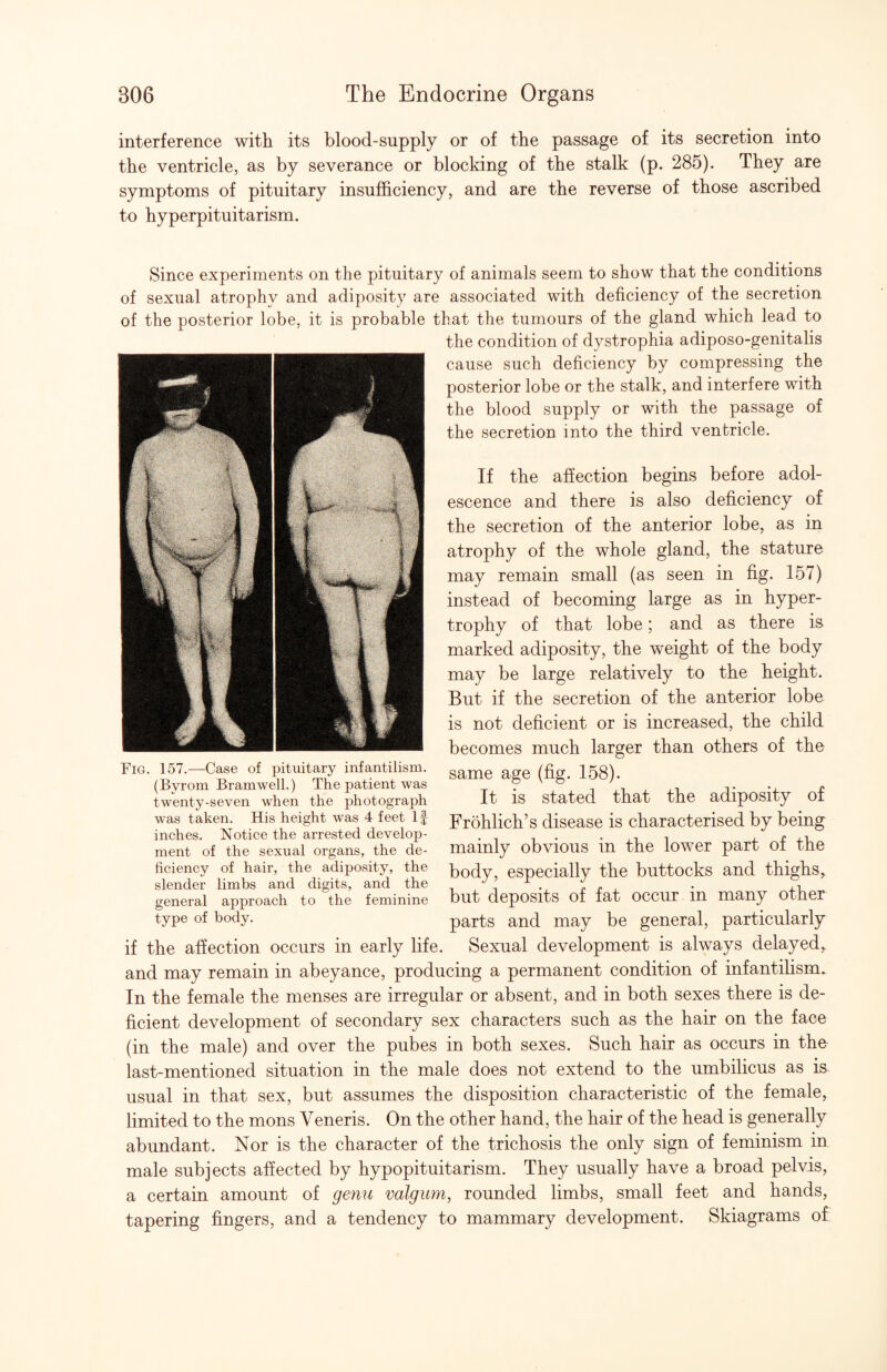 interference with its blood-supply or of the passage of its secretion into the ventricle, as by severance or blocking of the stalk (p. 285). They are symptoms of pituitary insufficiency, and are the reverse of those ascribed to hyperpituitarism. Since experiments on the pituitary of animals seem to show that the conditions of sexual atrophy and adiposity are associated with deficiency of the secretion of the posterior lobe, it is probable that the tumours of the gland which lead to the condition of dystrophia adiposo-genitalis cause such deficiency by compressing the posterior lobe or the stalk, and interfere with the blood supply or with the passage of the secretion into the third ventricle. Fig. 157.—Case of pituitary infantilism. (Byrom Bramwell.) The patient was twenty-seven when the photograph was taken. His height was 4 feet If inches. Notice the arrested develop¬ ment of the sexual organs, the de¬ ficiency of hair, the adiposity, the slender limbs and digits, and the general approach to the feminine type of body. if the affection occurs in early life If the afiection begins before adol¬ escence and there is also deficiency of the secretion of the anterior lobe, as in atrophy of the whole gland, the stature may remain small (as seen in fig. 157) instead of becoming large as in hyper¬ trophy of that lobe; and as there is marked adiposity, the weight of the body may be large relatively to the height. But if the secretion of the anterior lobe is not deficient or is increased, the child becomes much larger than others of the same age (fig. 158). It is stated that the adiposity of Frohlich’s disease is characterised by being mainly obvious in the lower part of the body, especially the buttocks and thighs^ but deposits of fat occur in many other parts and may be general, particularly Sexual development is always delayed,. and may remain in abeyance, producing a permanent condition of infantilism. In the female the menses are irregular or absent, and in both sexes there is de¬ ficient development of secondary sex characters such as the hair on the face (in the male) and over the pubes in both sexes. Such hair as occurs in the last-mentioned situation in the male does not extend to the umbilicus as is usual in that sex, but assumes the disposition characteristic of the female, limited to the mons Veneris. On the other hand, the hair of the head is generally abundant. Nor is the character of the trichosis the only sign of feminism in male subjects ahected by hypopituitarism. They usually have a broad pelvis, a certain amount of gemi valgum, rounded limbs, small feet and hands, tapering fingers, and a tendency to mammary development. Skiagrams of