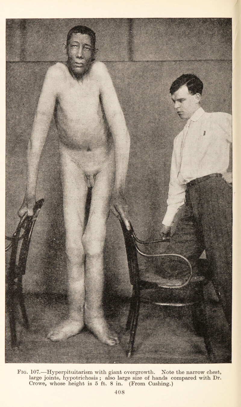 Fig. 107.—Hyperpituitarism with giant overgrowth. Note the narrow chest, large joints, hypotrichosis ; also large size of hands compared with Dr. Crowe, whose height is 5 ft. 8 in. (From Cushing.)