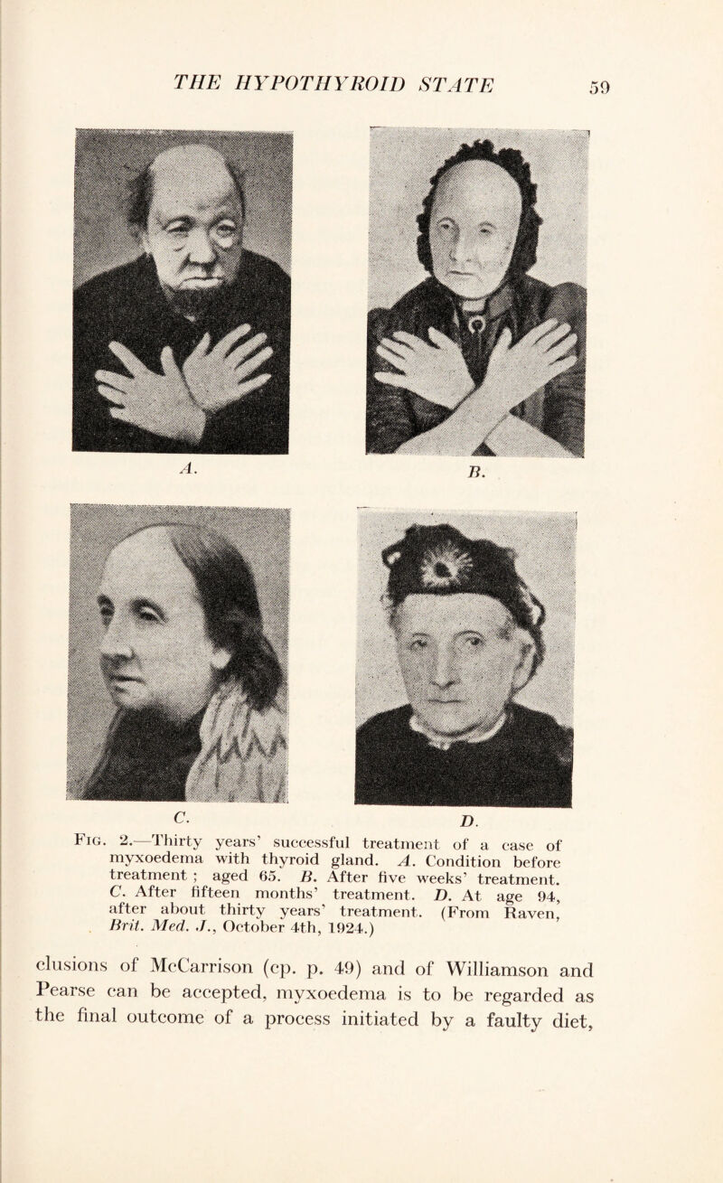C- D. Fig. 2.—Thirty years’ successful treatment of a case of myxoedema with thyroid gland. A. Condition before treatment ; aged 65. B. After five weeks’ treatment. C. After fifteen months’ treatment. D. At age 94, after about thirty years treatment. (From Raven, Brit. Med. ./., October 4t,h, 1924.) elusions of McCarrison (cp. p. 49) and of Williamson and Pearse can be accepted, myxoedema is to be regarded as the final outcome of a process initiated by a faulty diet,