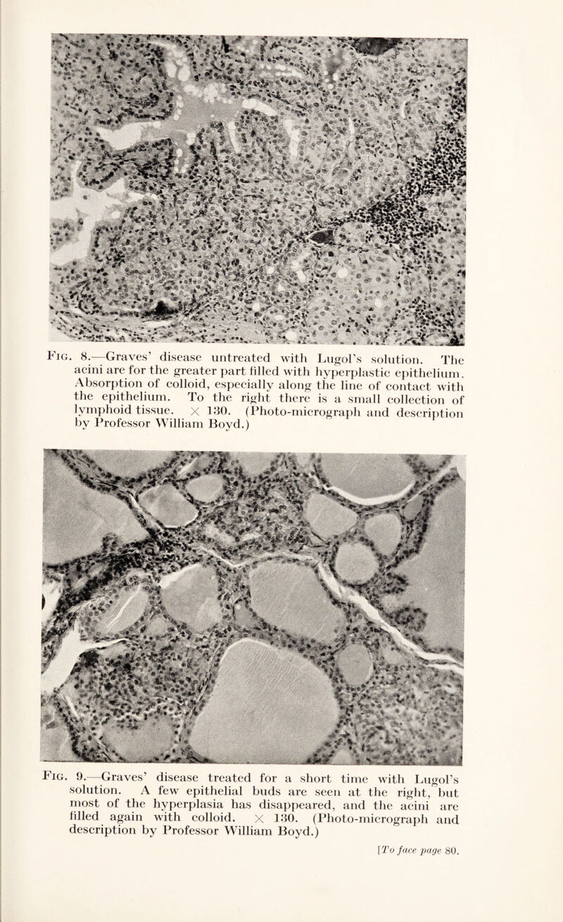 Fig. 8.—Graves’ disease untreated with Lugol’s solution. The acini are for the greater part filled with hyperplastic epithelium. Absorption of colloid, especially along the line of contact with the epithelium. To the right there is a small collection of lymphoid tissue, x 180. (Photo-micrograph and description by Professor William Boyd.) h ig. 9.—Graves’ disease treated for a short time with Lugol’s solution. A few epithelial buds are seen at the right, but most of the hyperplasia has disappeared, and the acini are hlled again with colloid. X 130. (Photo-micrograph and description by Professor William Boyd.) [To face page 80.