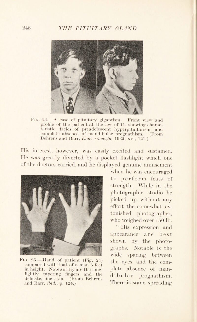 Fig. 24.—A case of pituitary gigantism. Front view and profile of the patient at the age of 11, showing charac¬ teristic facies of preadolescent hyperpituitarism and complete absence of mandibular prognathism. (From Behrens and Barr, Endocrinology, 1932, xvi, 121.) H is interest, however, was easily excited and sustained. He was greatly diverted by a poeket llaslilight which one of the doctors carried, and he displayed genuine amusement when he was encouraged to perform feats of strength. While in the photographic studio he picked up without any effort the somewhat as¬ tonished photographer, who weighed over 150 lb. “ H is expression and appearance are b e s t shown by the photo¬ graphs. Notable is the wide spacing between 4ig. 2.).- Hand of patient (Fig 24) the eyes and the corn- compared with that of a man 6 feet J in height. Noteworthy are the long, plete absence of man- lightly tapering fingers and the dibular prognathism. delicate, fine skin, (from Behrens r 1 ® and Barr, ibid., p. 124.) There is some spreading