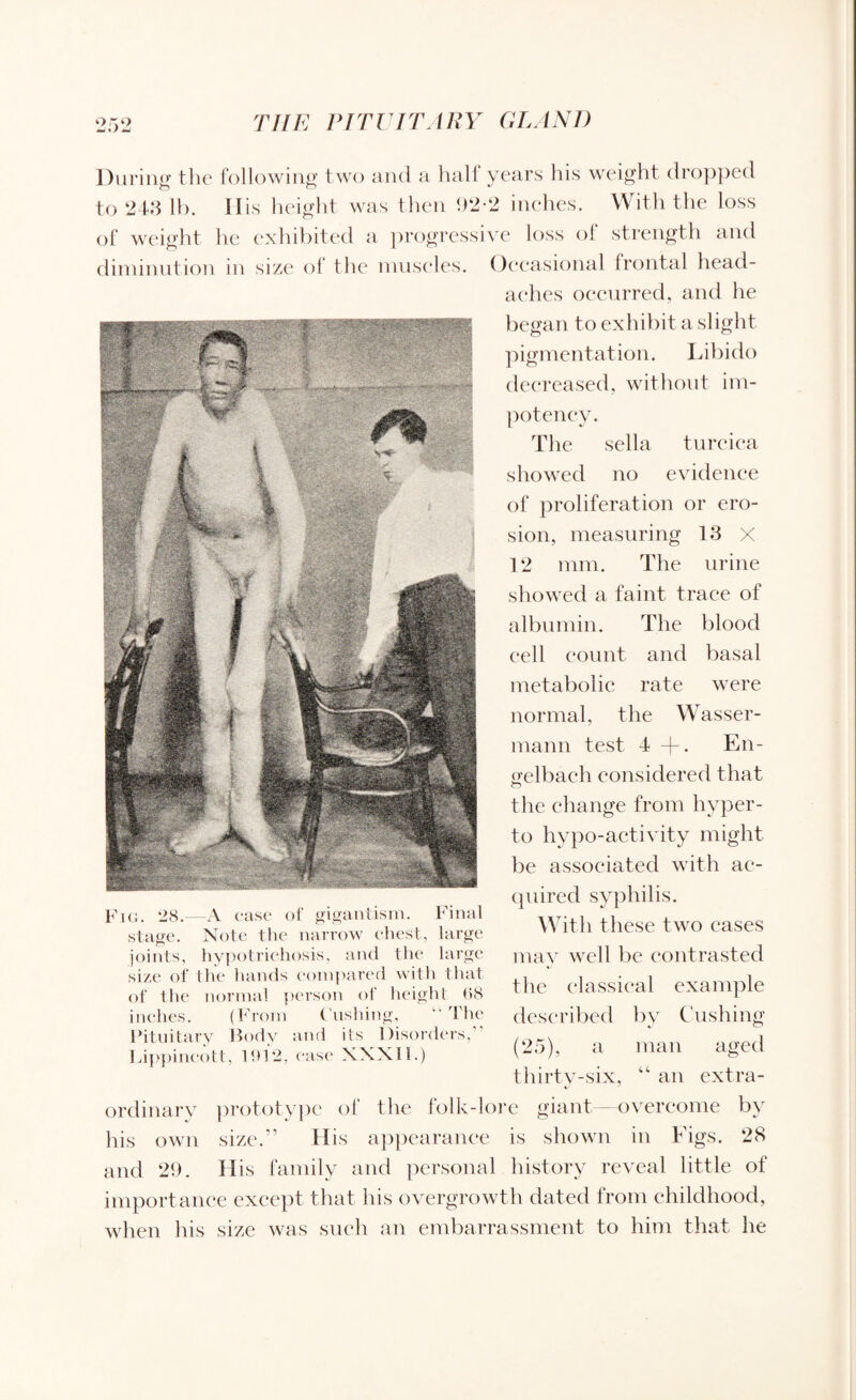 During the following two and a half years his weight dropped to 243 lb. I lis height was then 92-2 inches. With the loss of weight lie exhibited a progressive loss of strength and diminution in size of the muscles. Occasional frontal head¬ aches occurred, and he began to exhibit a slight pigmentation. Libido decreased, without int- potency. The sella turcica showed no evidence of proliferation or ero¬ sion, measuring 13 X 12 mm. The urine showed a faint trace of albumin. The blood cell count and basal metabolic rate were normal, the Wasser- mann test 4 + . En- p'elbach considered that o the change from hyper- to hypo-activity might be associated with ac¬ quired syphilis. With these two cases may well be contrasted the classical example described bv Cushing (25), a man aged thirty-six, “ an extra¬ Fig. 28.—A ease of gigantism. Final stage. Note the narrow chest, large joints, hypotrichosis, and the large size of the hands compared with that of the normal person of height 88 inches. (From Cushing, “The Pituitary Body and its Disorders, Lippincott, 1912, ease XXXII.) ordinary prototype of the folk-lore giant—overcome by his own size.” His appearance is shown in Figs. 28 and 29. His family and personal history reveal little of importance except, that his overgrowth dated from childhood, when his size was such an embarrassment to him that he