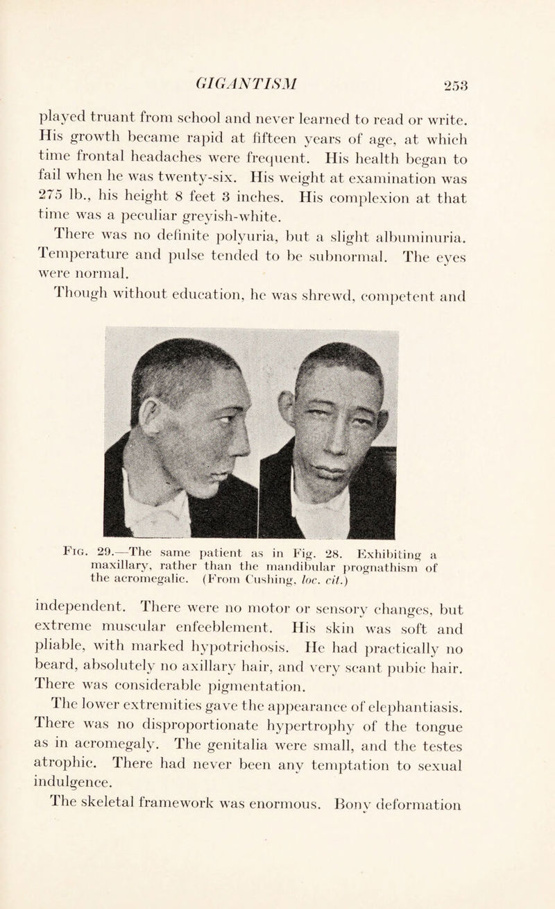 played truant from school and never learned to read or write. His growth became rapid at fifteen years of age, at which time frontal headaches were frequent. His health began to fail when he was twenty-six. His weight at examination was 275 lb., his height 8 feet 3 inches. His complexion at that time was a peculiar greyish-white. There was no definite polyuria, but a slight albuminuria. Temperature and pulse tended to be subnormal. The eyes were normal. 1 hough without education, he was shrewd, competent and Fig. 29.—The same patient as in Fig. 28. Exhibiting a maxillary, rather than the mandibular prognathism of the acromegalic. (From Cushing, loc. cit.) independent. There were no motor or sensory changes, but extreme muscular enfeeblement. His skin was soft and pliable, with marked hypotrichosis. He had practically no beard, absolutely no axillary hair, and very scant pubic hair. There was considerable pigmentation. The lower extremities gave the appearance of elephantiasis. There was no disproportionate hypertrophy of the tongue as in acromegaly. The genitalia were small, and the testes atrophic. There had never been any temptation to sexual indulgence. The skeletal framework was enormous. Bonv deformation