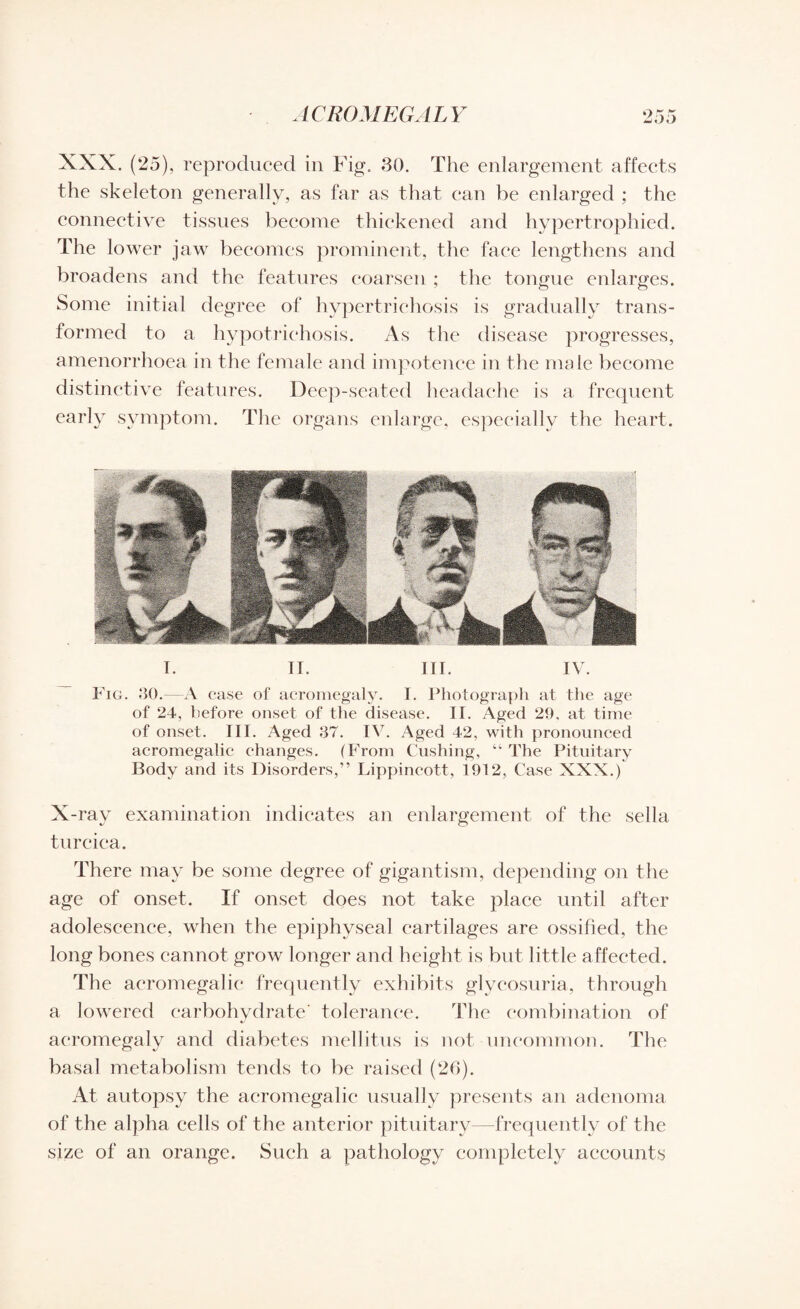 ACROMEGALY 9 30 XXX. (25), reproduced in Fig. 30. The enlargement affects the skeleton generally, as far as that can be enlarged ; the connective tissues become thickened and hypertrophied. The lower jaw becomes prominent, the face lengthens and broadens and the features coarsen ; the tongue enlarges. Some initial degree of hypertrichosis is gradually trans¬ formed to a hypotrichosis. As the disease progresses, amenorrhoea in the female and impotence in the male become distinctive features. Deep-seated headache is a frequent early symptom. The organs enlarge, especially the heart. I. II. III. IV. Fig. 30.—A case of acromegaly. I. Photograph at the age of 24, before onset of the disease. II. Aged 29. at time of onset. III. Aged 37. IV. Aged 42, with pronounced acromegalic changes. (From Cushing, “ The Pituitary Body and its Disorders,” Lippincott, 1912, Case XXX.) X -ray examination indicates an enlargement of the sella turcica. There may be some degree of gigantism, depending on the age of onset. If onset does not take place until after adolescence, when the epiphyseal cartilages are ossified, the long bones cannot grow longer and height is but little affected. The acromegalic frequently exhibits glycosuria, through a lowered carbohydrate' tolerance. The combination of acromegaly and diabetes mellitus is not uncommon. The basal metabolism tends to be raised (26). At autopsy the acromegalic usually presents an adenoma of the alpha cells of the anterior pituitary—frequently of the size of an orange. Such a pathology completely accounts