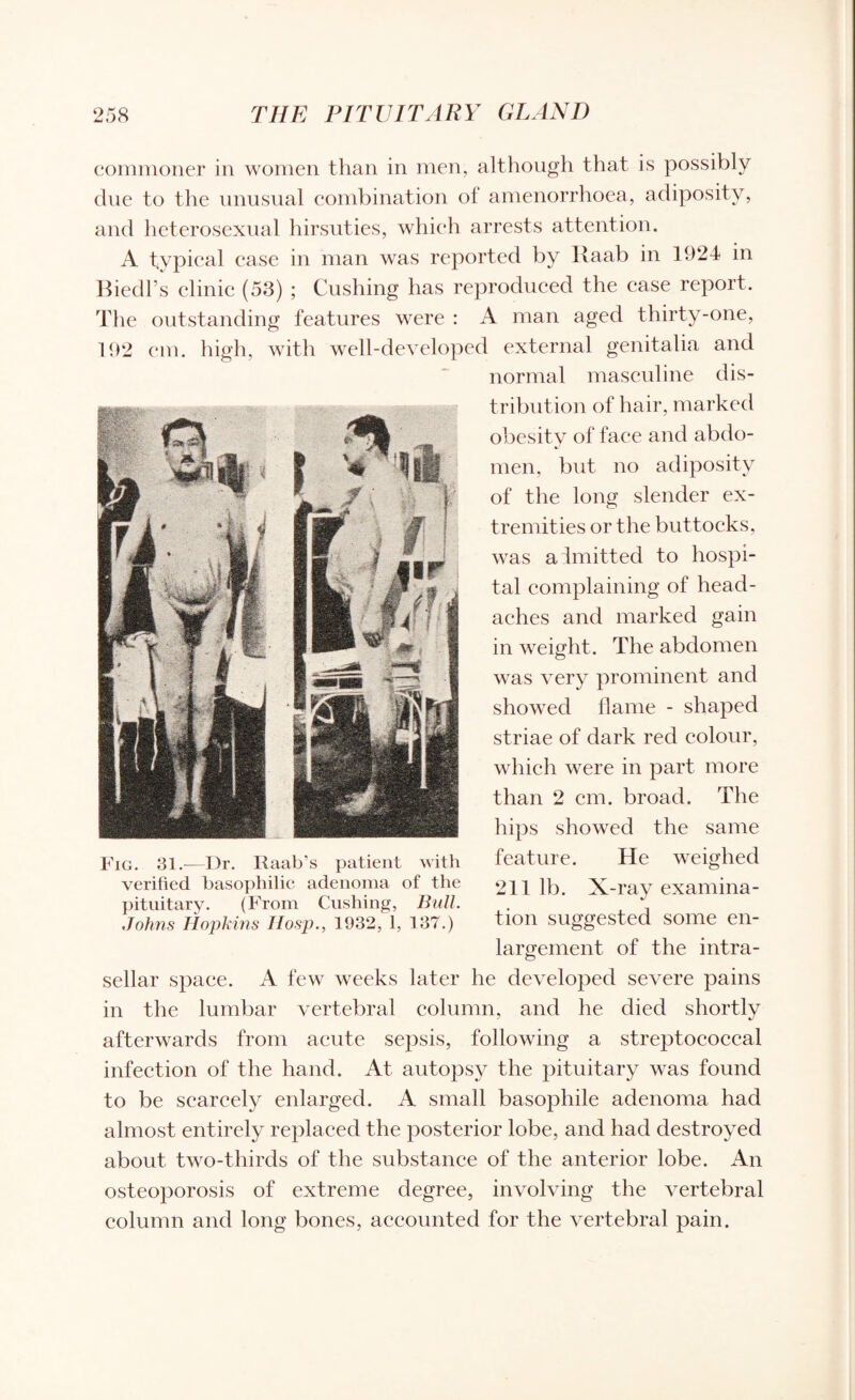 commoner in women than in men, although that is possibly due to the unusual combination ol amenorrhoea, adiposity, and heterosexual hirsuties, which arrests attention. A typical case in man was reported by Raab in 1924 in Biedl’s clinic (53) ; Cushing has reproduced the case report. The outstanding features were : A man aged thirty-one, 192 cm. high, with well-developed external genitalia and normal masculine dis¬ tribution of hair, marked obesity of face and abdo¬ men, but no adiposity of the long slender ex¬ tremities or the buttocks, was admitted to hospi¬ tal complaining of head¬ aches and marked gain in weight. The abdomen was very prominent and showed flame - shaped striae of dark red colour, which were in part more than 2 cm. broad. The hips showed the same feature. He weighed 211 lb. X-ray examina¬ tion suggested some en¬ largement of the intra¬ sellar space. A few weeks later he developed severe pains in the lumbar vertebral column, and he died shortly afterwards from acute sepsis, following a streptococcal infection of the hand. At autopsy the pituitary was found to be scarcely enlarged. A small basopliile adenoma had almost entirely replaced the posterior lobe, and had destroyed about two-thirds of the substance of the anterior lobe. An osteoporosis of extreme degree, involving the vertebral column and long bones, accounted for the vertebral pain. Fig. 31.-—Dr. Raab’s patient with verified basophilic adenoma of the pituitary. (From Cushing, Bull. Johns Hopkins Hosp., 1932, 1, 137.)