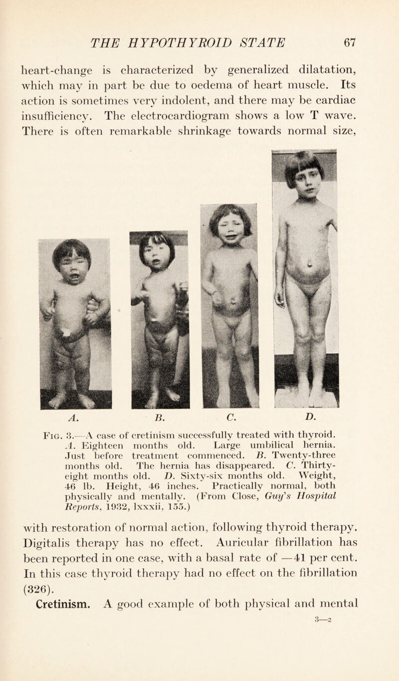 heart-change is characterized by generalized dilatation, which may in part be due to oedema of heart muscle. Its action is sometimes very indolent, and there may be cardiac insufficiency. The electrocardiogram shows a low T wave. There is often remarkable shrinkage towards normal size, A. B. C. D. Fig. 3.—A case of cretinism successfully treated with thyroid. A. Eighteen months old. Large umbilical hernia. Just before treatment commenced. B. Twenty-three months old. The hernia has disappeared. C. Thirty- eight months old. D. Sixty-six months old. Weight, 46 lb. Height, 46 inches. Practically normal, both physically and mentally. (From Close, Guy's Hospital Reports, i932, Ixxxii, 155.) with restoration of normal action, following thyroid therapy. Digitalis therapy has no effect. Auricular fibrillation has been reported in one case, with a basal rate of —41 per cent. In this case thyroid therapy had no effect on the fibrillation (326). Cretinism. A good example of both physical and mental 3—2