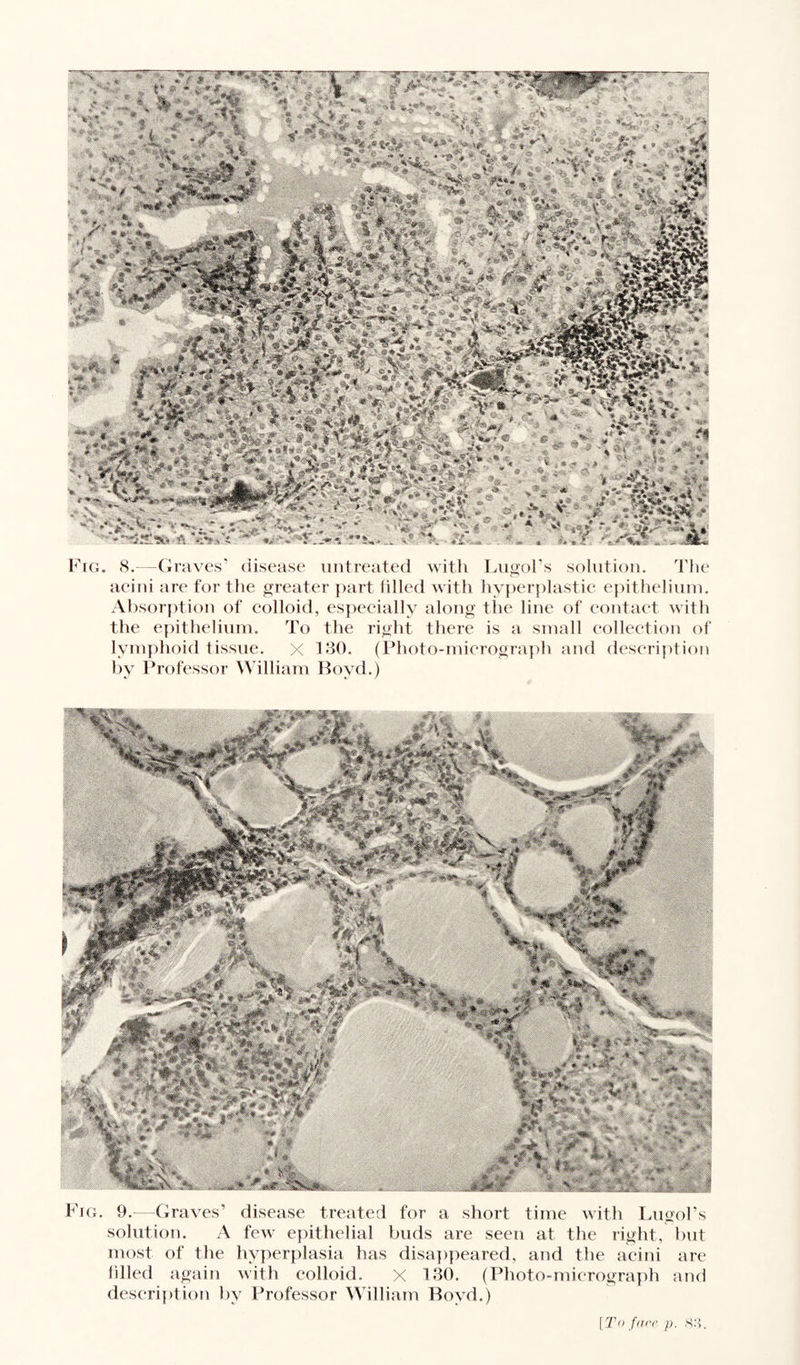 Fig. 8.—Graves’ disease untreated with Lugol’s solution. The acini are for the greater part filled with hyperplastic epithelium. Absorption of colloid, especially along the line of contact with the epithelium. To the right there is a small collection of lymphoid tissue. X 130. (Photo-micrograph and description by Professor William Boyd.) Fig. 9.—Graves’ disease treated for a short time with Lugol's solution. A few epithelial buds are seen at the right, but most of the hyperplasia has disappeared, and the acini are filled again with colloid. x 130. (Photo-micrograph and description by Professor William Boyd.) [To fare p. 88.