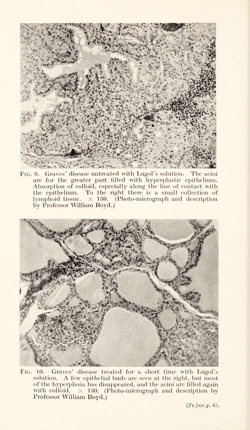 ■■*** •*-‘f^^ ?,v-« -I*., r ^'*.’v' rrl-S: X '.'i v^:tk Fig. 9. Graves’ disease untreated with Lugol’s solution. The aeini are for the greater part filled with hyperplastic epithelium. Absorption of colloid, especially along the line of contact with the epithelium. To the right there is a small collection of lymphoid tissue. X l.‘M). (Photo-micrograph and description by Professor William Boyd.) Fig. 10. Graves’ disease treated for a short time with laigoPs solution. A few e])ithelial buds ar(“ seen at the right, but most of the hyperplasia has disapjieared, and the aeini are tilled again with colloid. X 100. (Photo-micrograph and description by Professor William Boyd.) [To face p. 03.